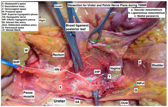 Cervix　Dissection International expert consensus on the surgical anatomic classification of  radical hysterectomies - American Journal of Obstetrics & Gynecology