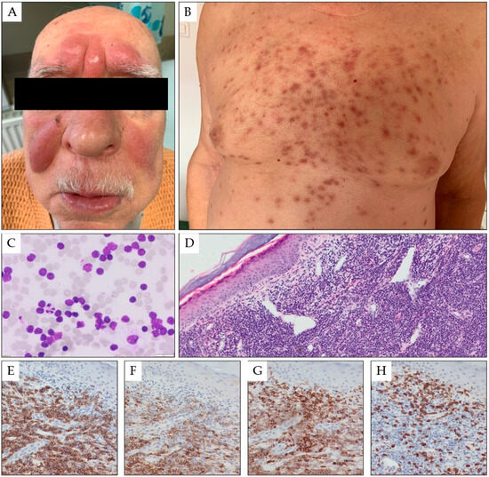 Cancers | Free Full-Text | Leukemia Cutis&mdash;The Current View on  Pathogenesis, Diagnosis, and Treatment