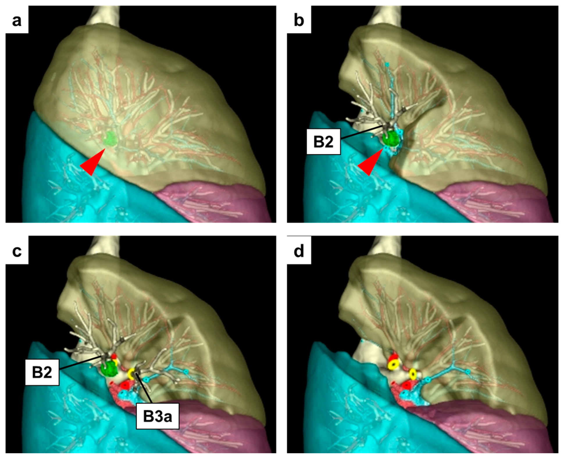 Cancers Free FullText Harnessing 3DCT Simulation and Planning for Enhanced Precision