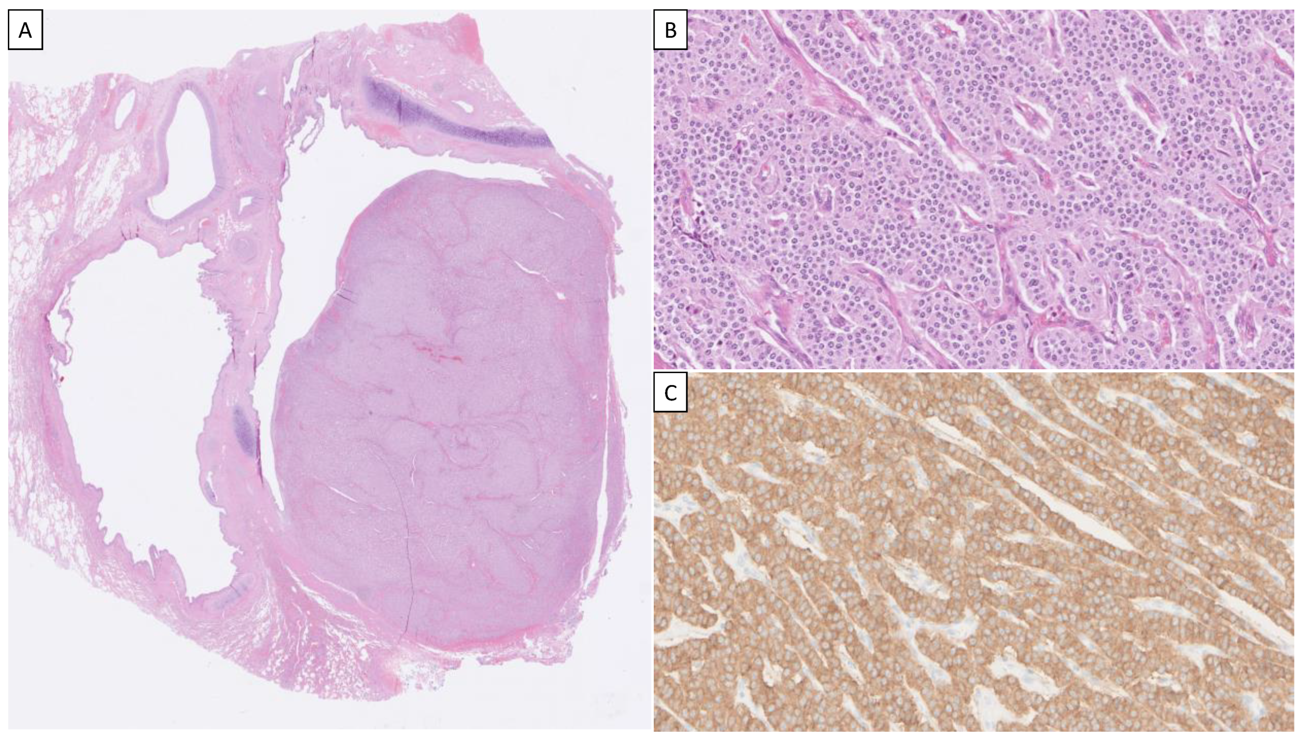 Cancers | Free Full-Text | Lung Carcinoids: A Comprehensive Review.