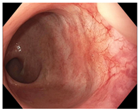 Cancers 15 05535 i004