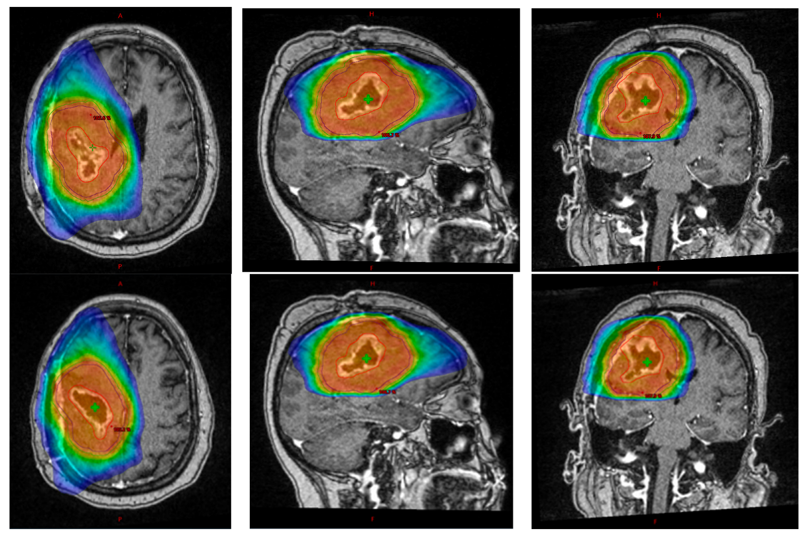 Hypofractionation in Glioblastoma: An Overview of Palliative