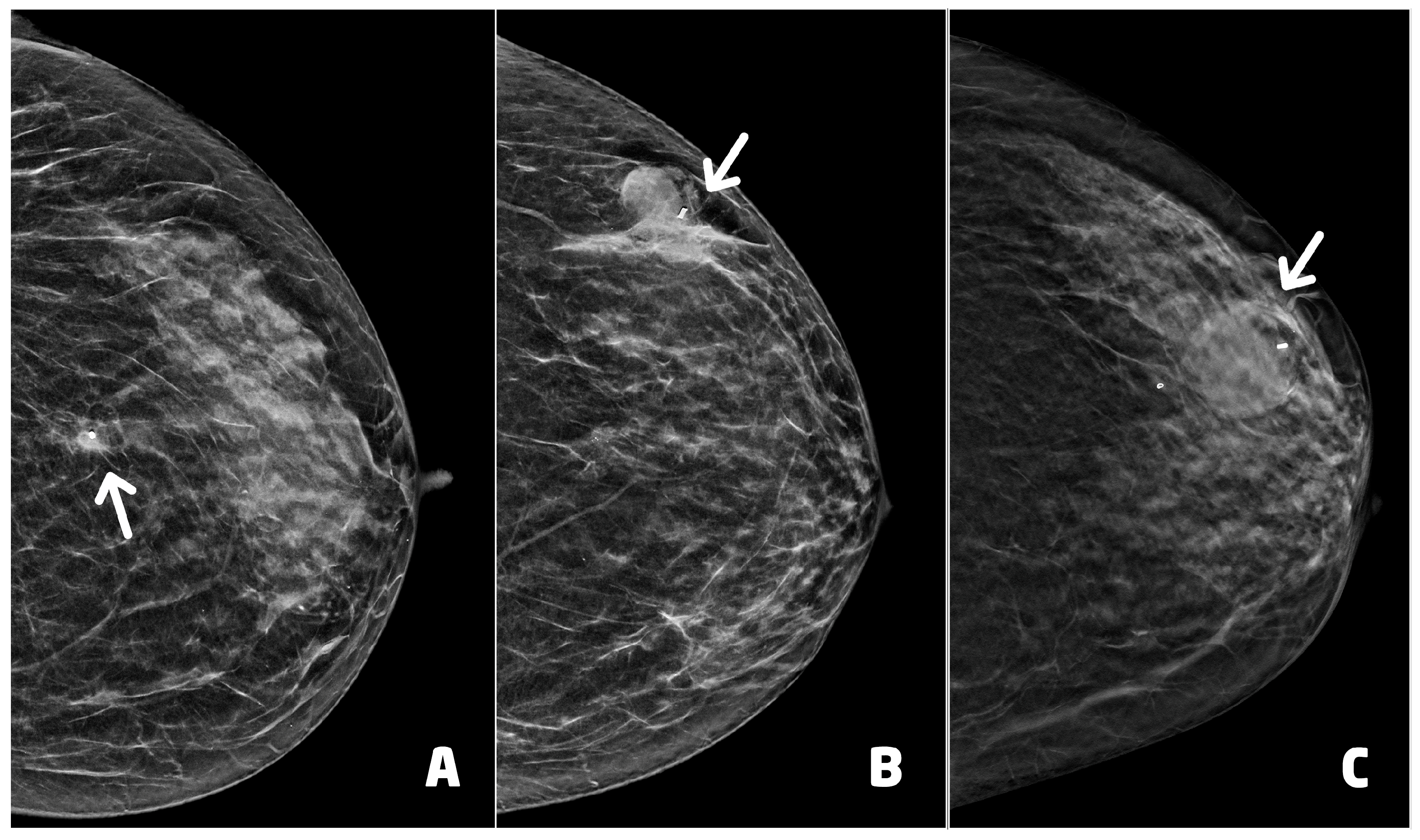 Clip migration after stereotactic vacuum-assisted breast biopsy with the  patient in the decubitus position