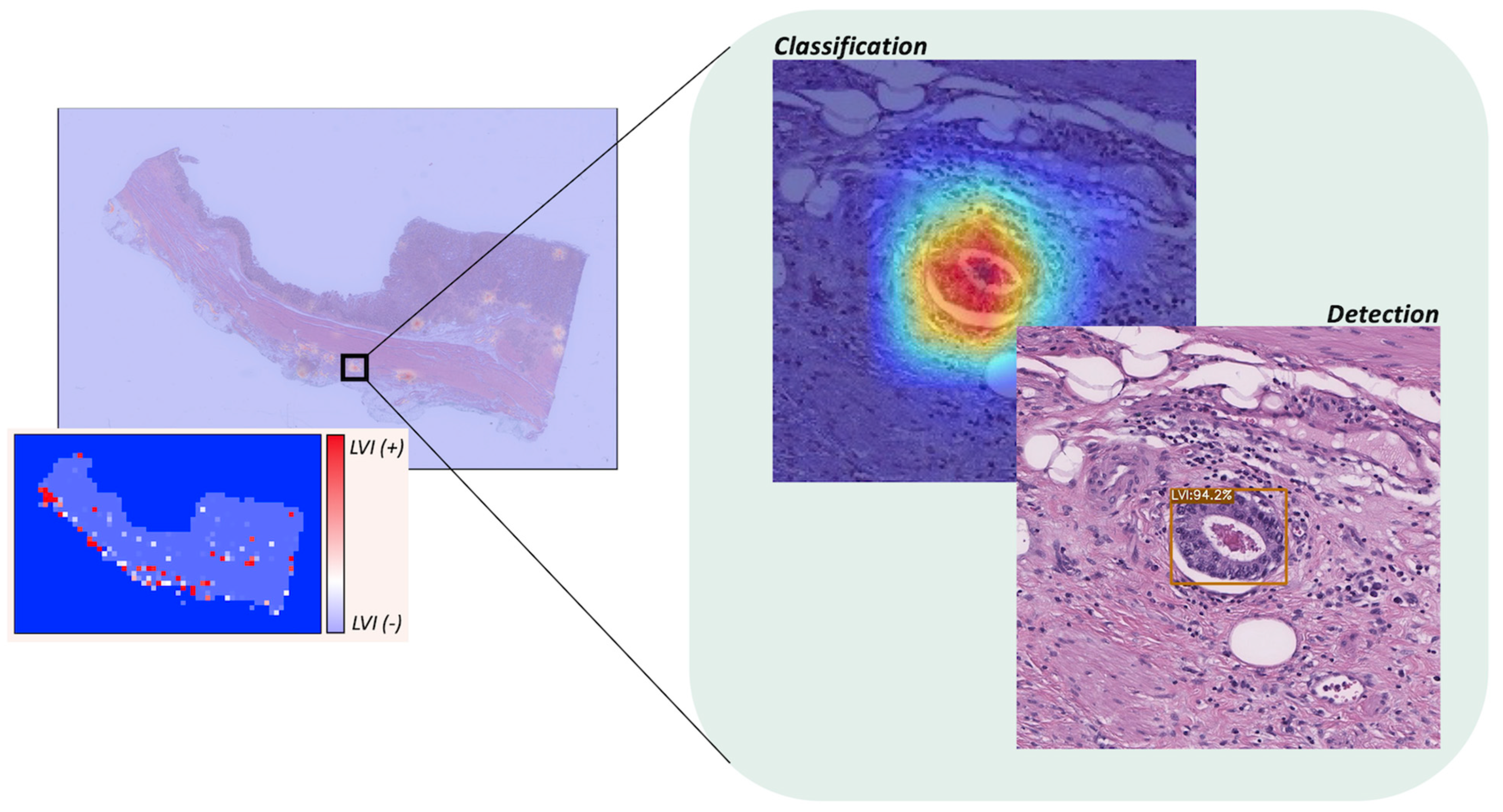 Ensemble Deep Learning Model to Predict Lymphovascular Invasion in Gastric  Cancer