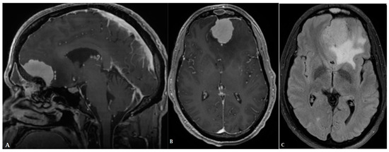 Advances in Neuro-Oncological Imaging: An Update on Diagnostic 