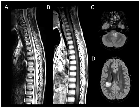 健康・医学 Cancer in the spine Spinal Cancer: What You Should Know
