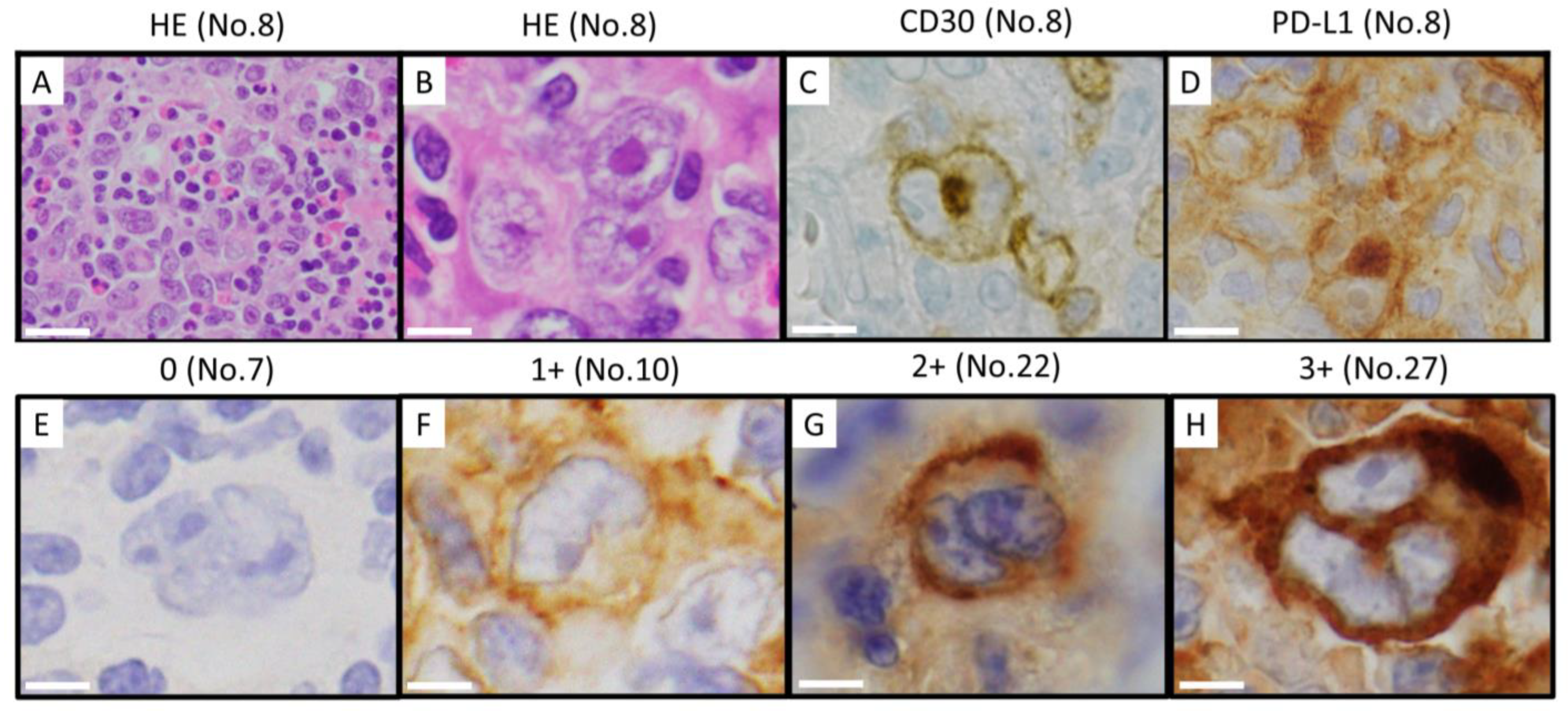 激安ブランド Number Copy Analysis Lymphoma Hodgkin Classic in 9p24.1 of 健康・医学