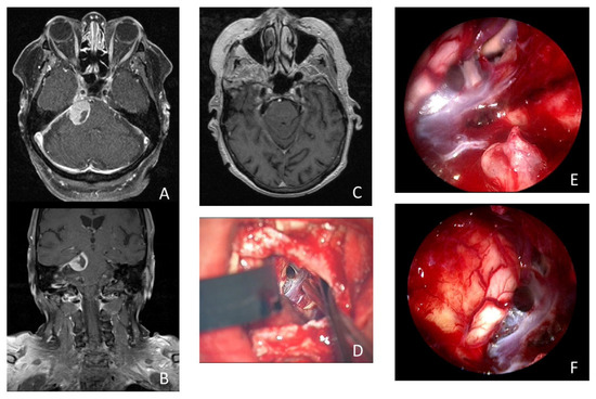 Endoscopic-Assisted Microsurgical Meningioma Resection in the