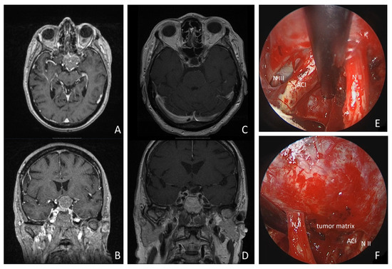 Endoscopic-Assisted Microsurgical Meningioma Resection in the