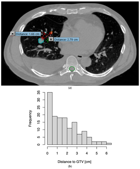 ウルトラ A Prospective Study on Deep Inspiration Breath Hold Thoracic
