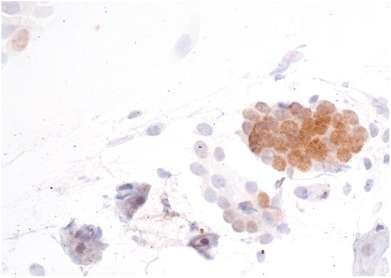 P16/Ki67 Dual Staining in Glandular Cell Abnormalities of