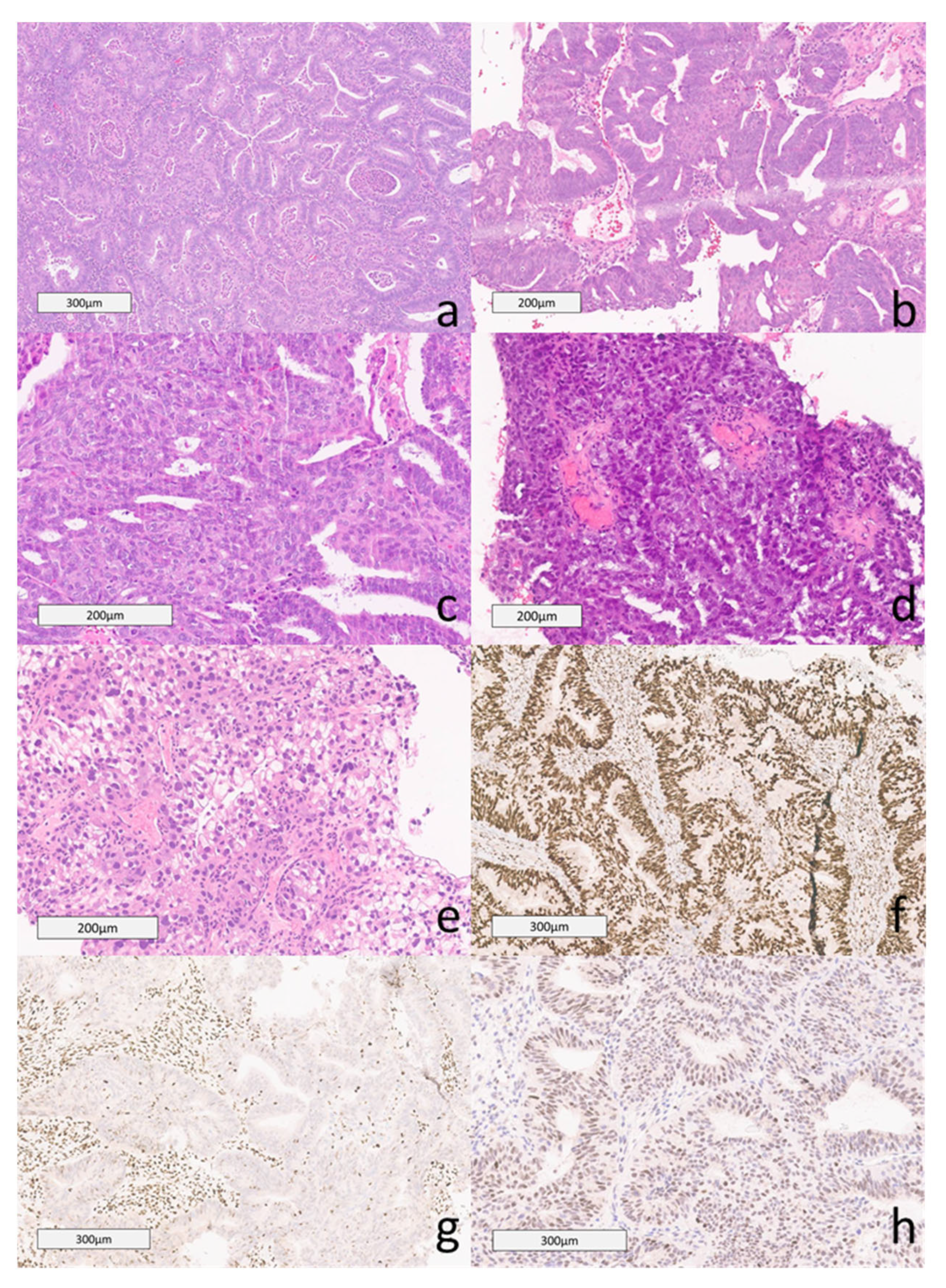 Endometrial Cancer: 2023 Revised FIGO Staging System and the Role 