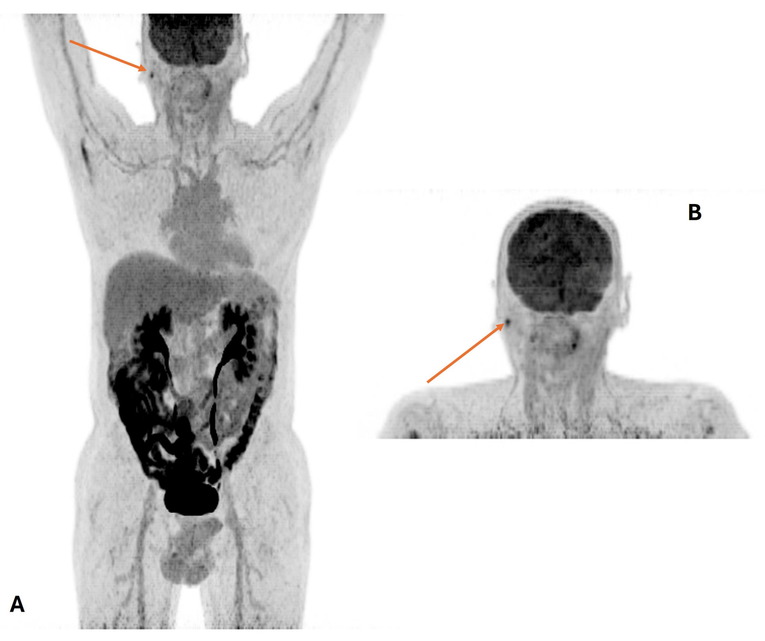 Role of 18F-FDG PET/CT in Head and Neck Squamous Cell Carcinoma 