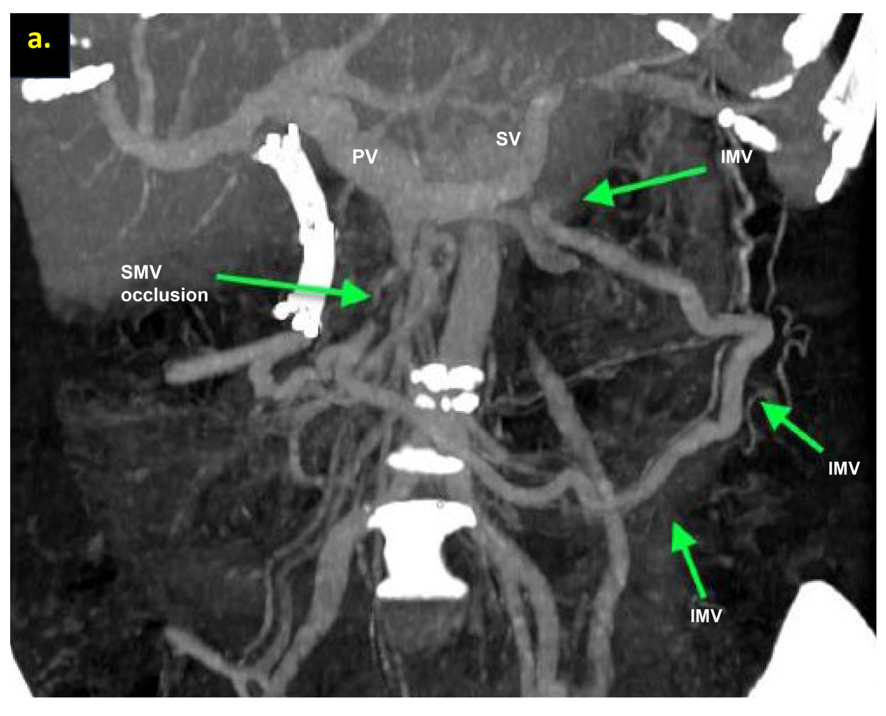 Cancers 16 02234 g007a Cancers 16 02234 g007a