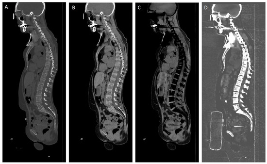 Cancers | Free Full-Text | Calcium-Based Imaging of the Spine at Dual ...