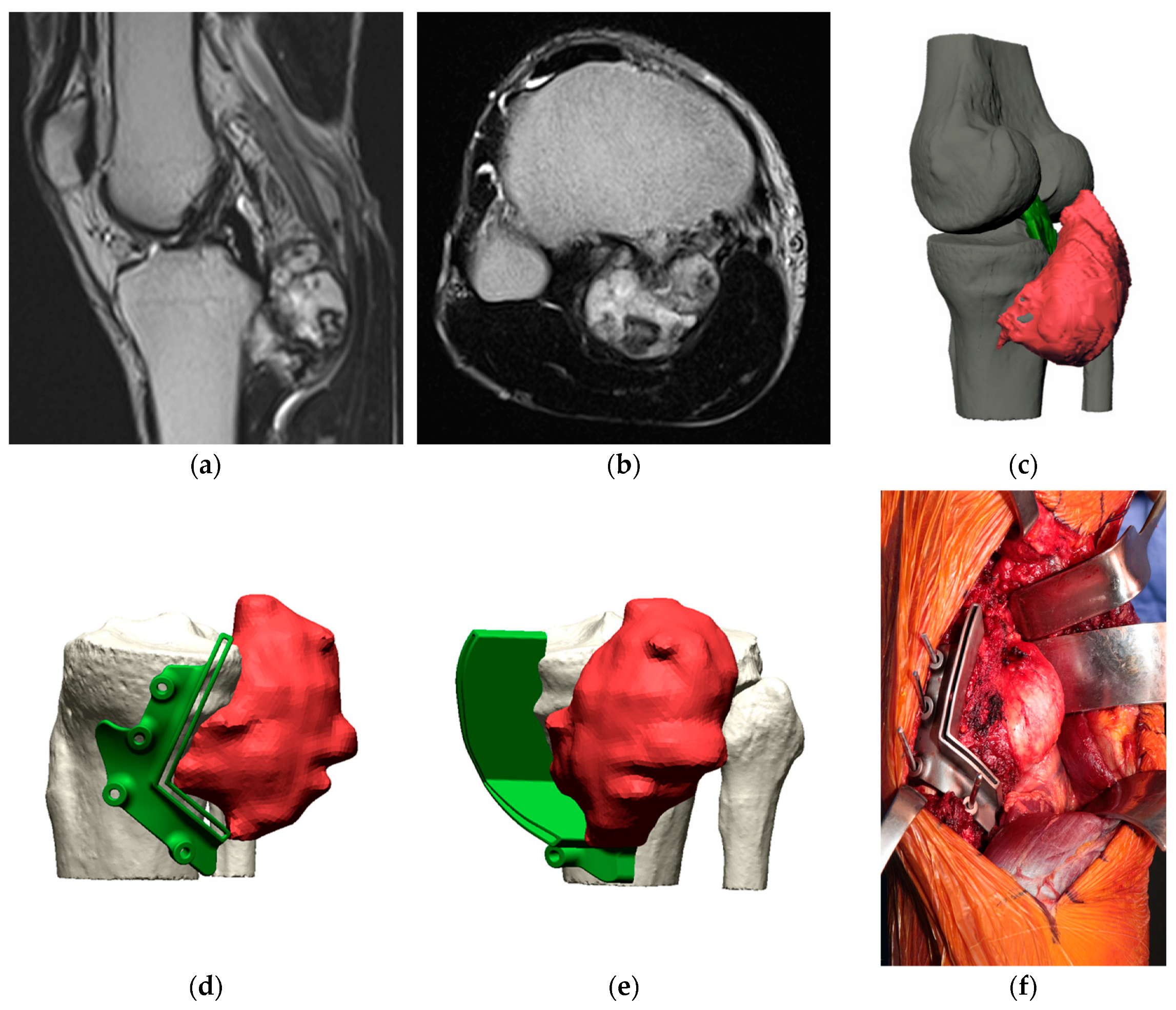 Joint-Sparing Resection of Juxta-Articular Primary Tumors of
