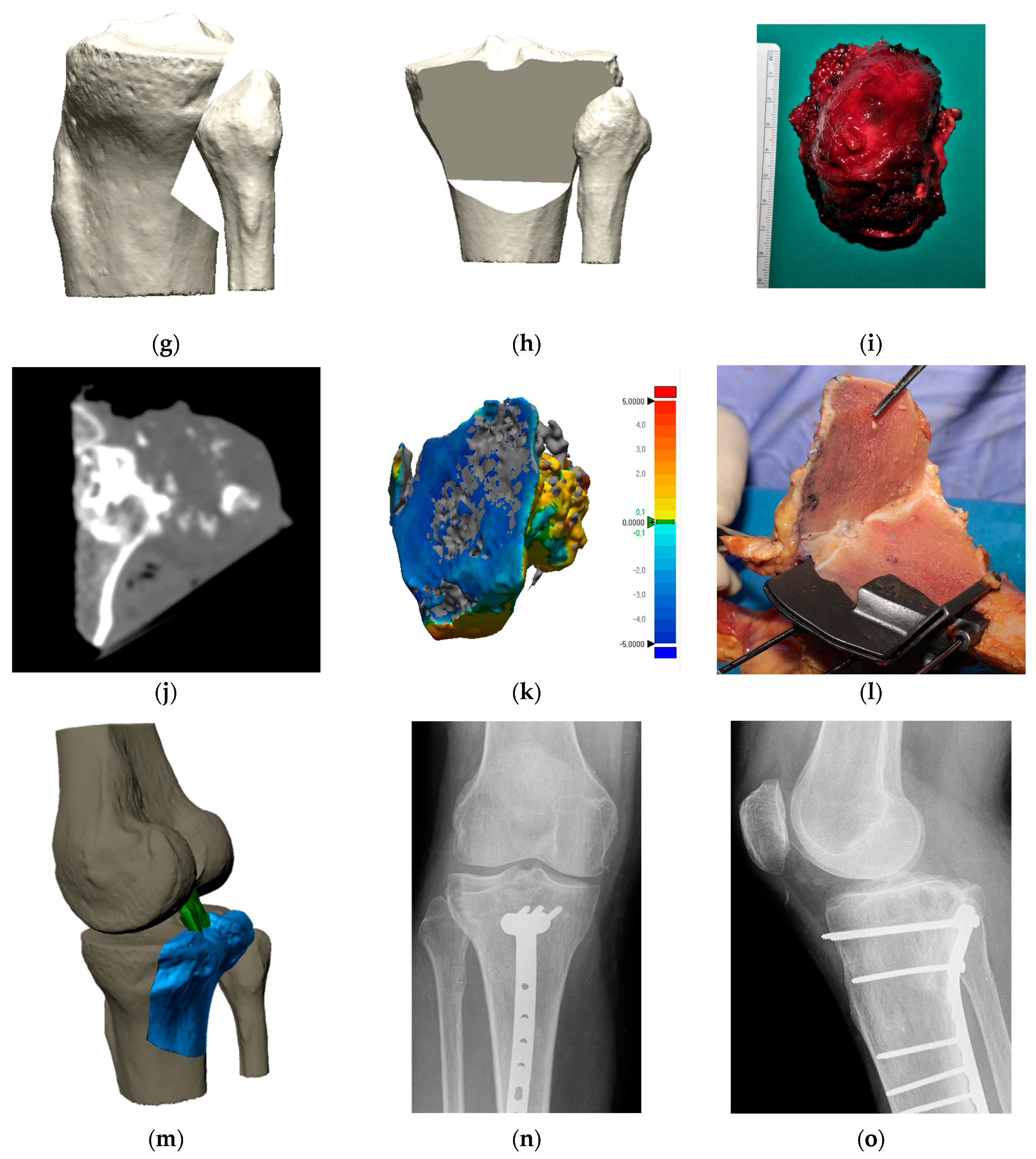 Joint-Sparing Resection of Juxta-Articular Primary Tumors of