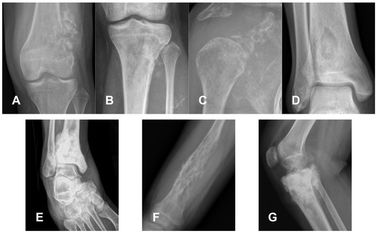 Multimodal Imaging of Osteosarcoma: From First Diagnosis to Radiomics