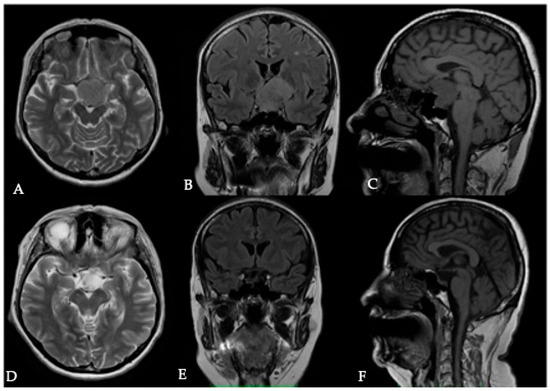 Optimizing Surgical Management of Anterior Skull Base