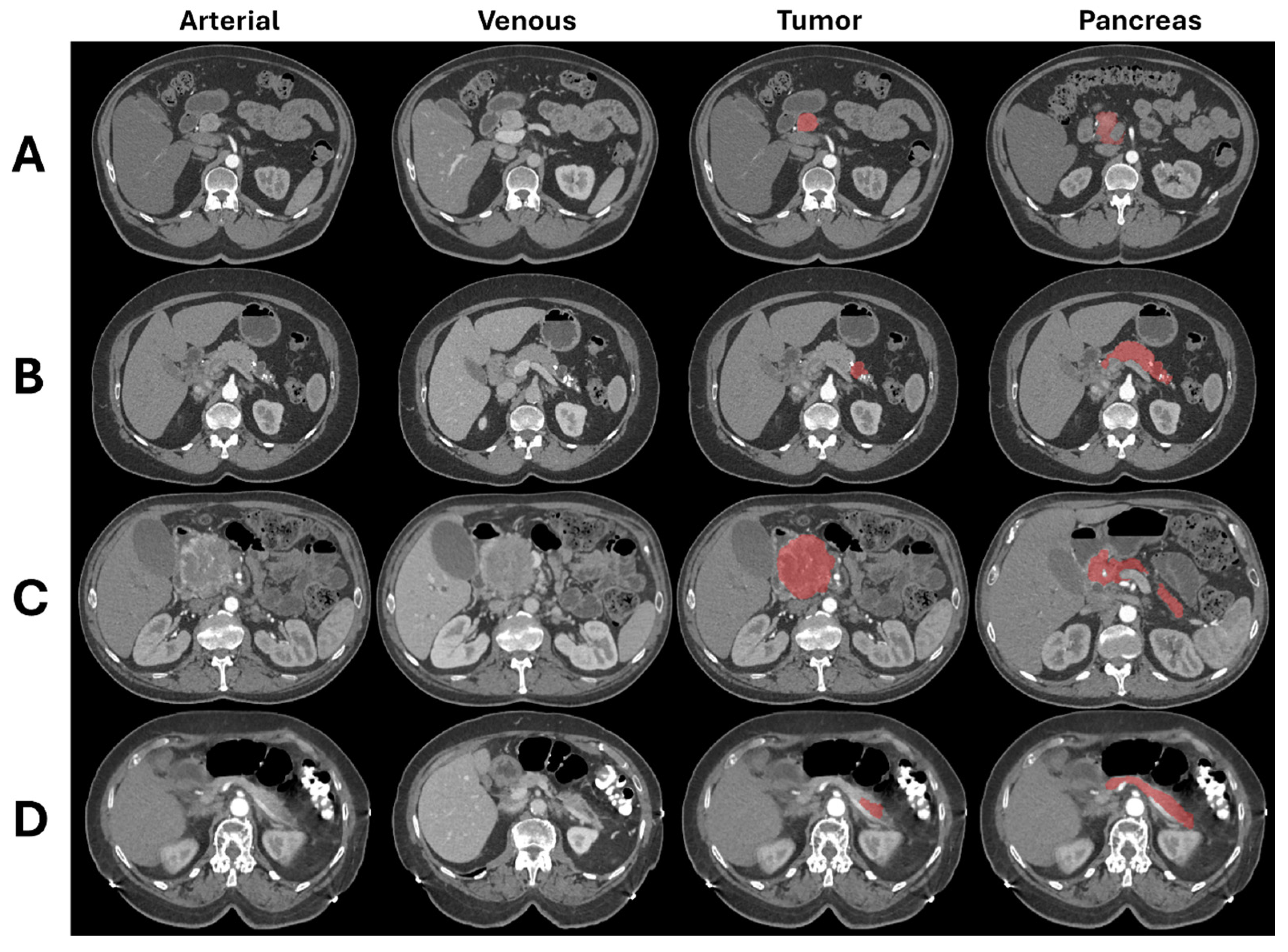 AFIP　Tumors of the Pancreas 【新品】 Tumors of the Pancreas (Afip Atlas of Tumor Pathology; 4th