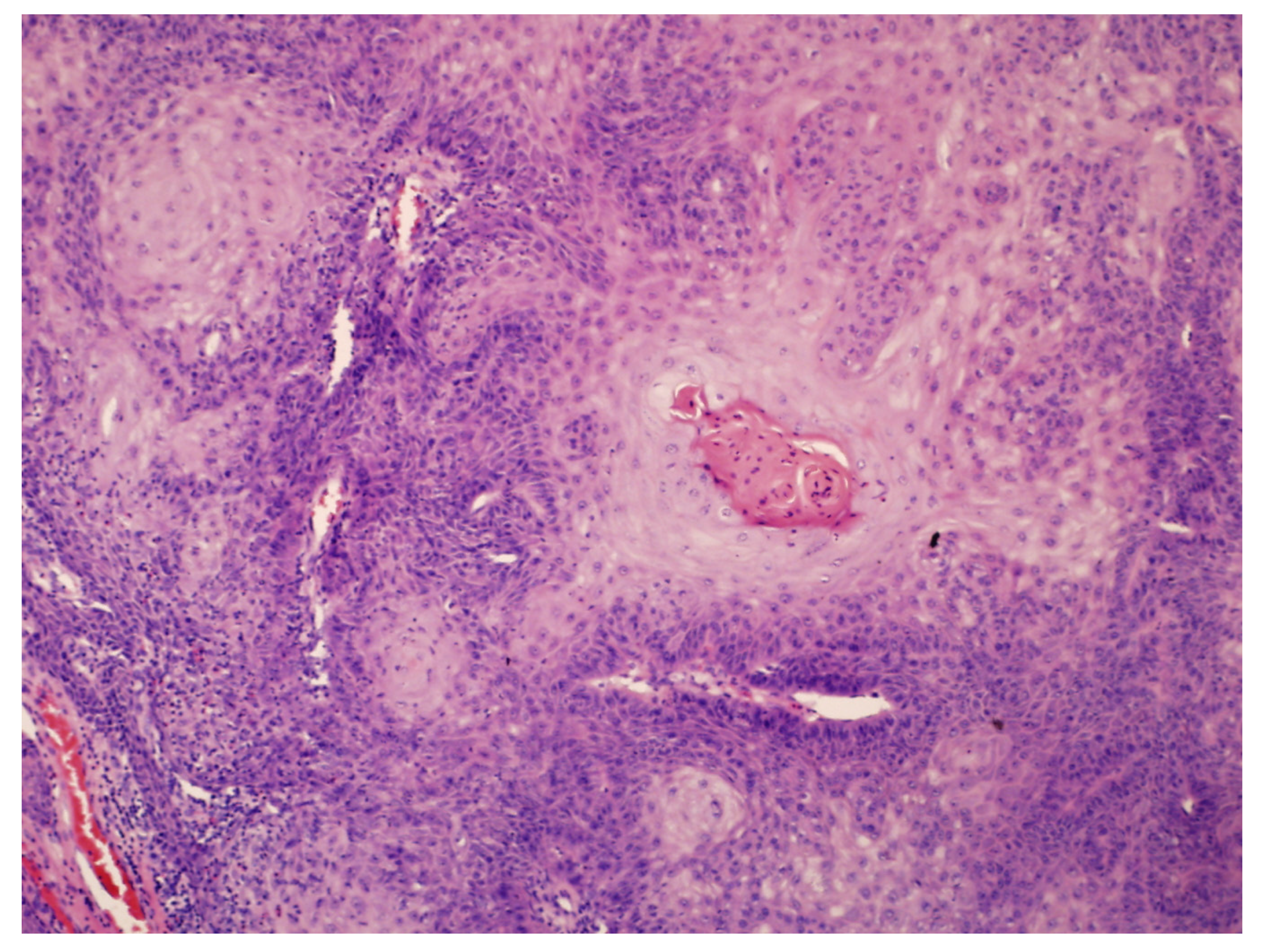 Verrucous carcinoma arising from a previous cystic lesion: a