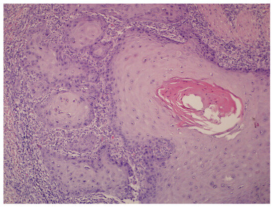 Squamous Cell Carcinoma and Its Rare Variant, Carcinoma