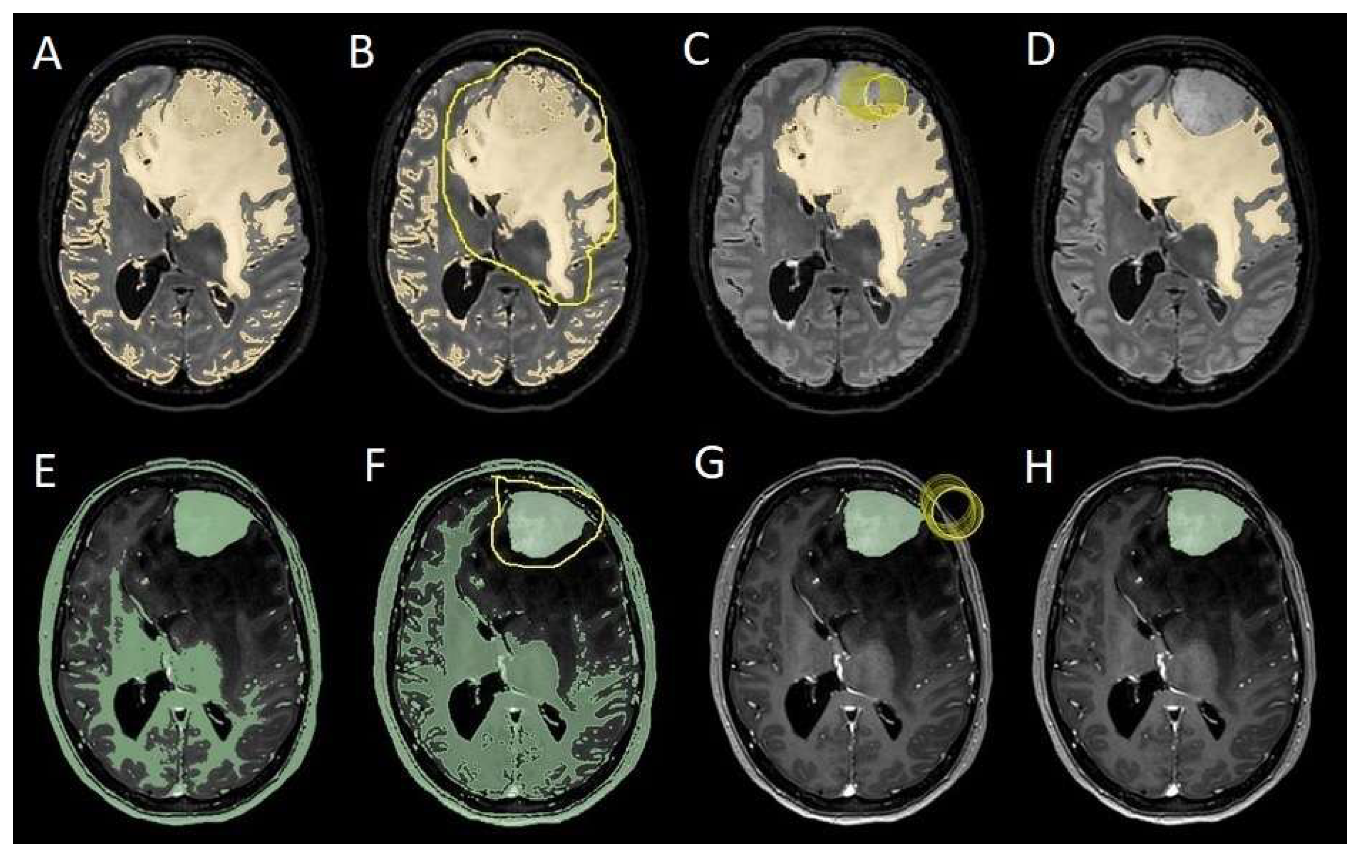 Cancers 17 01523 g005