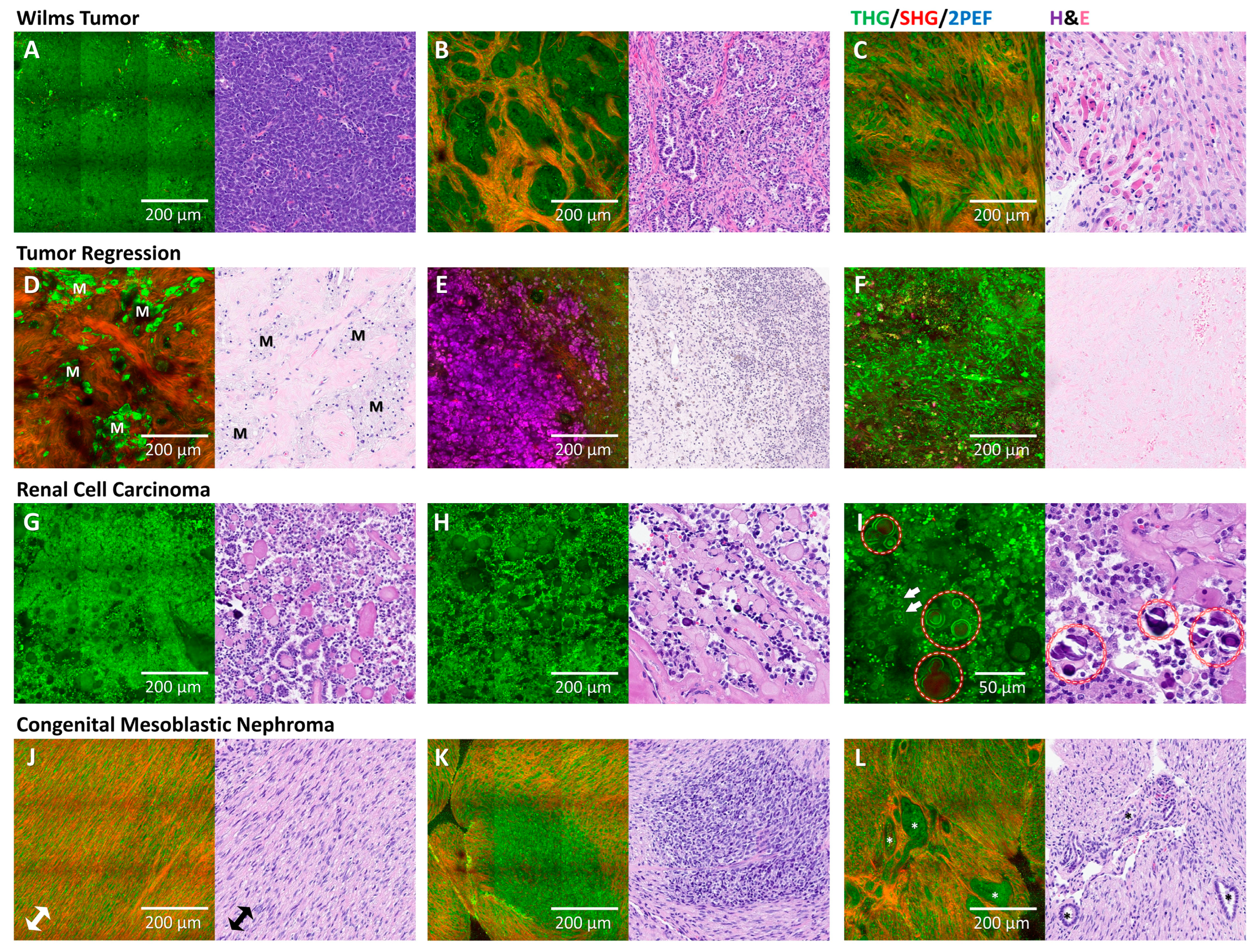 Cancers 17 01693 g003