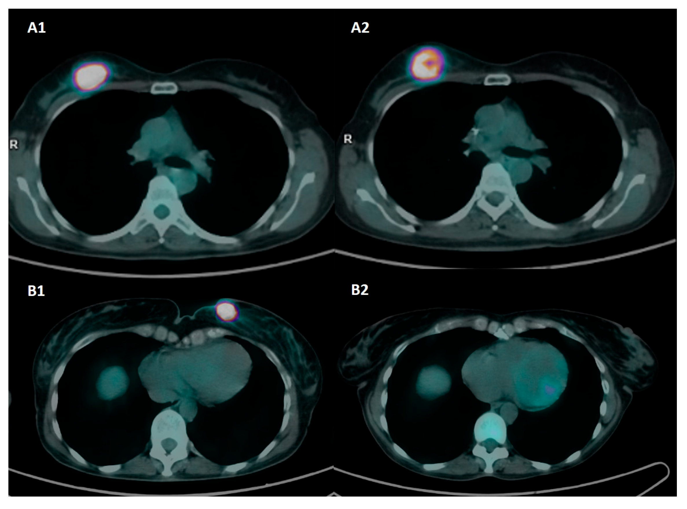 Diagnostic Breast Imaging 第2版 Diagnostic Breast Imaging: Mammography, Sonography, MRI and