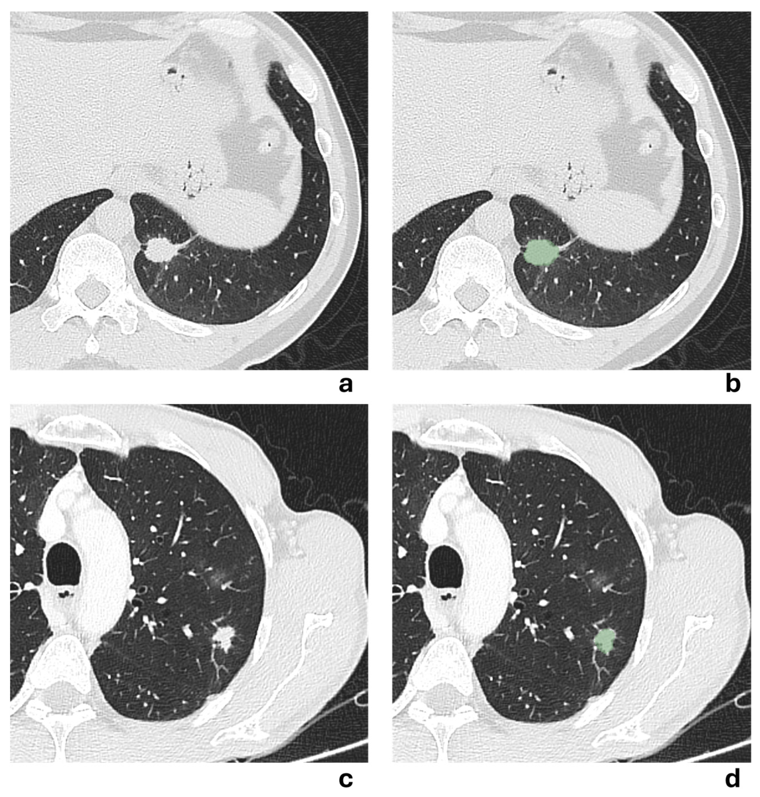 Cancers 17 04001 g005