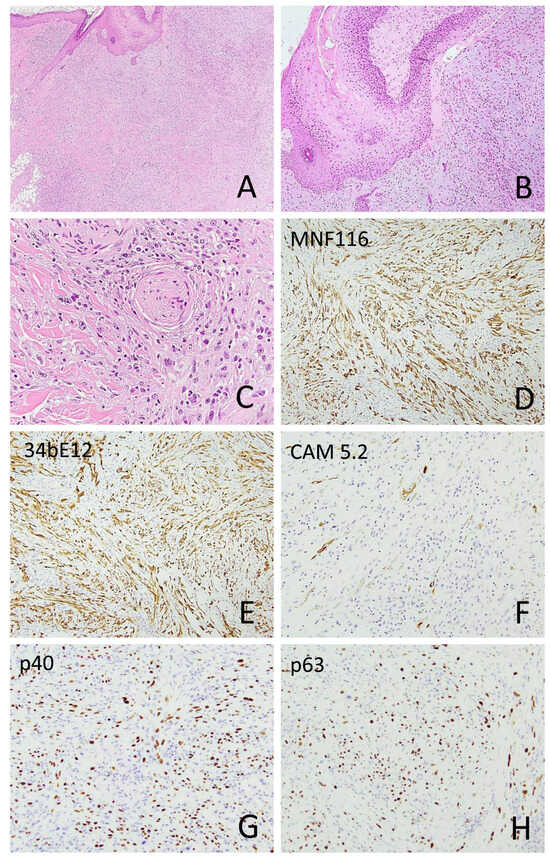 Sarcomatoid Squamous Cell Carcinoma and Its Mimics: A Meta-Analysis of ...