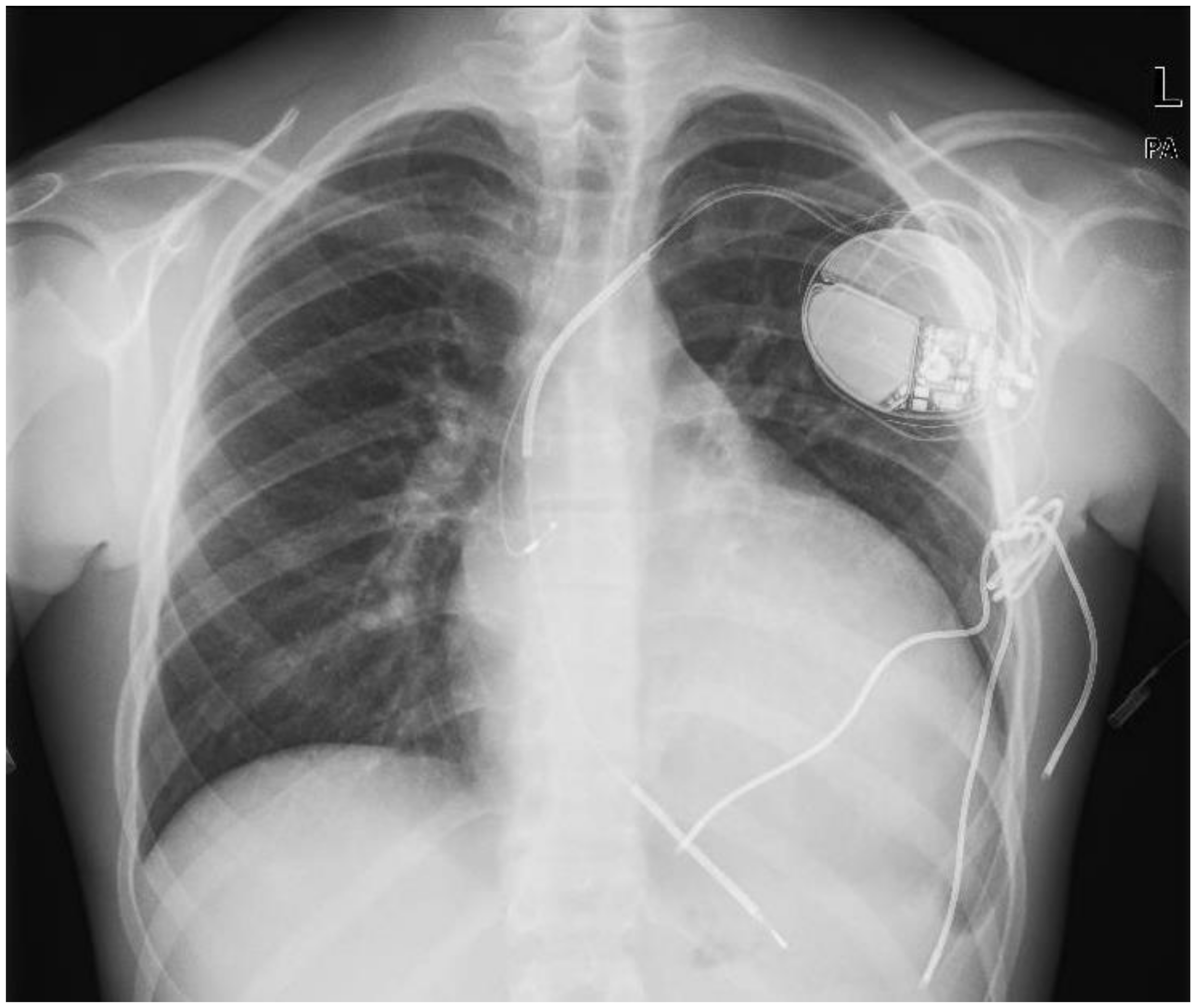 Free FullText Azygos Vein ICD Lead Implantation