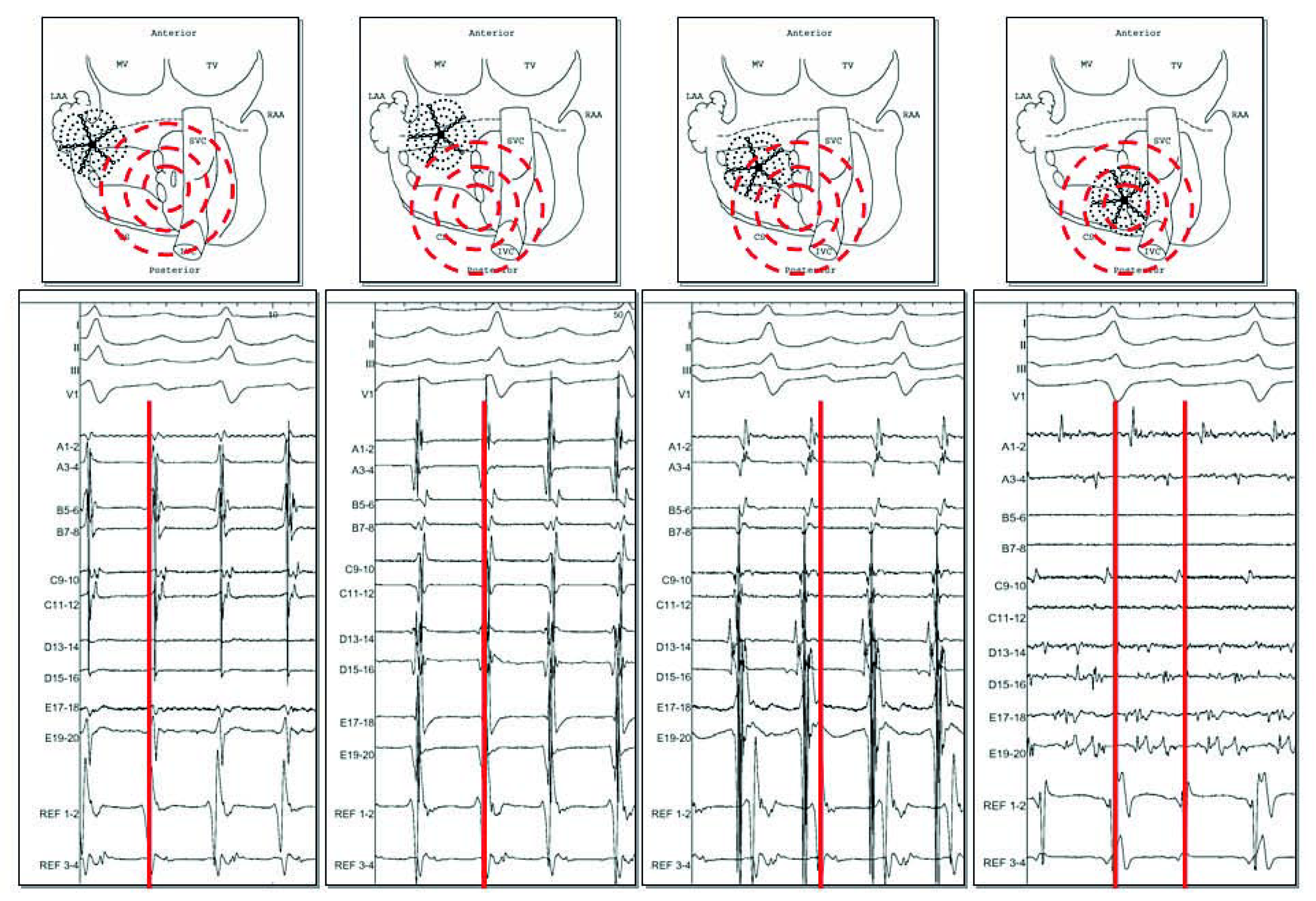 Cardiovascmed 11 00039 g005 Cardiovascmed 11 00039 g005