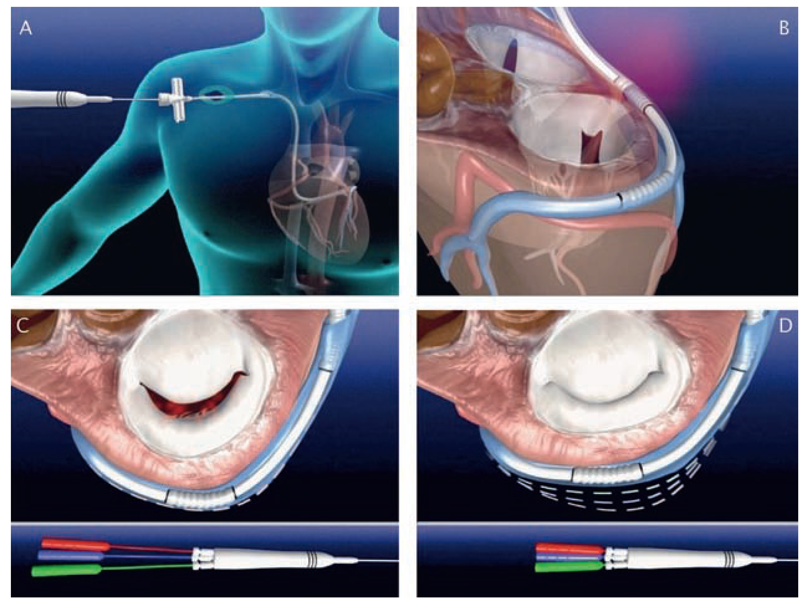 Cardiovascmed 11 00209 g003 Cardiovascmed 11 00209 g003