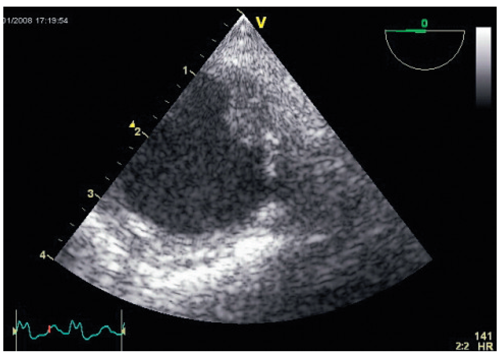 Cardiovascmed 12 00020 g003