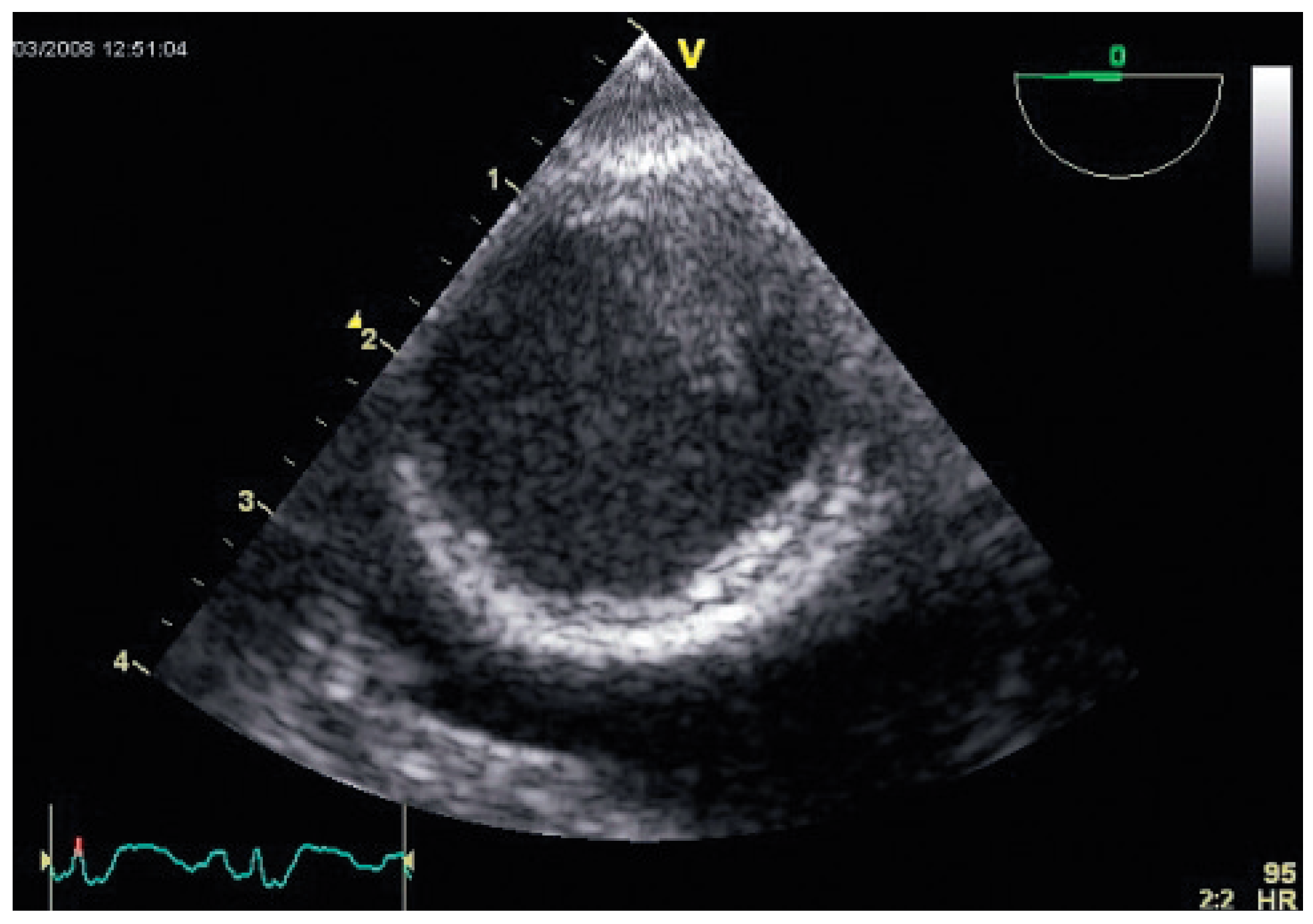 Cardiovascmed 12 00020 g004