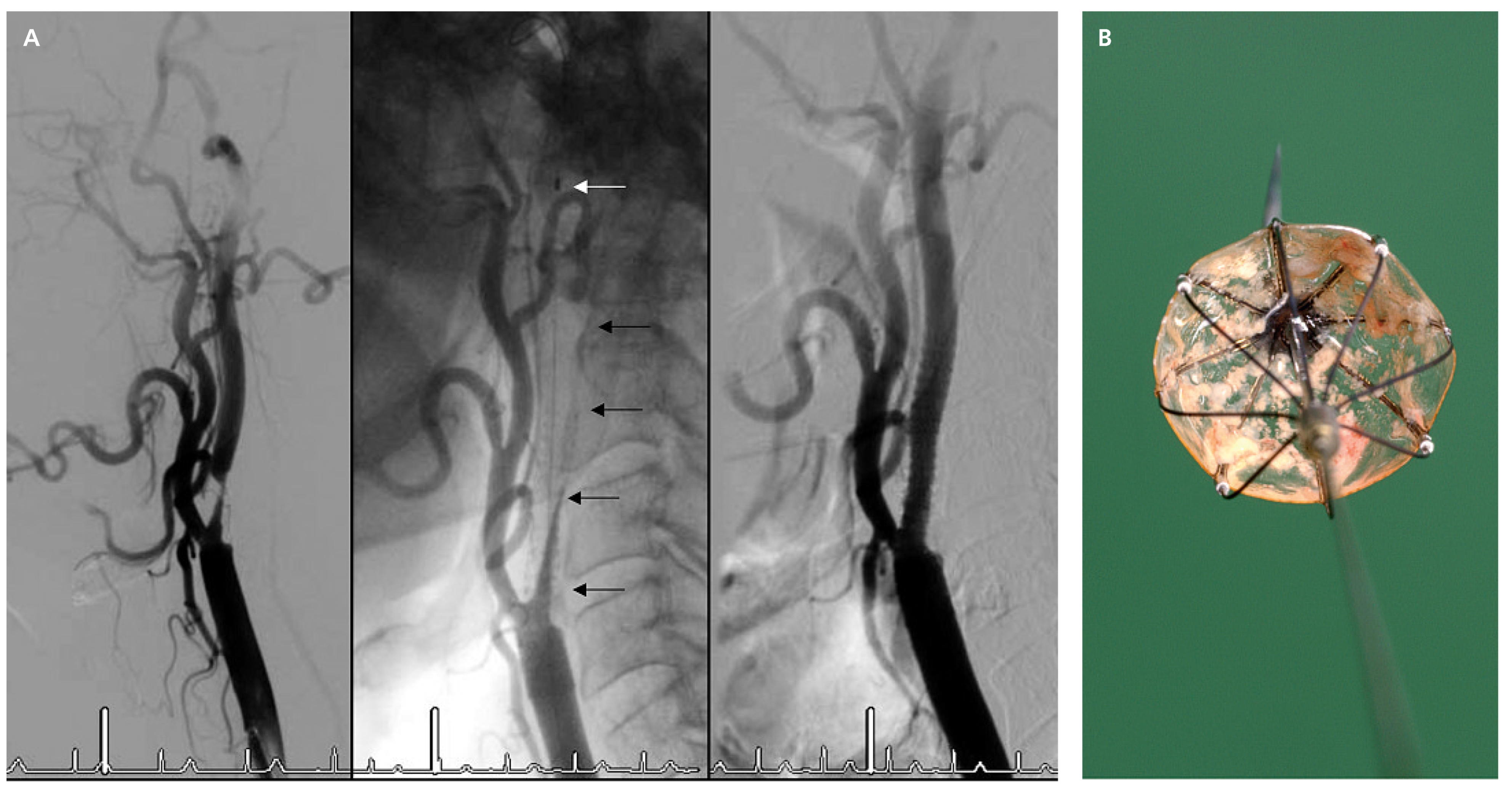 Cardiovascmed 12 00045 g005 Cardiovascmed 12 00045 g005