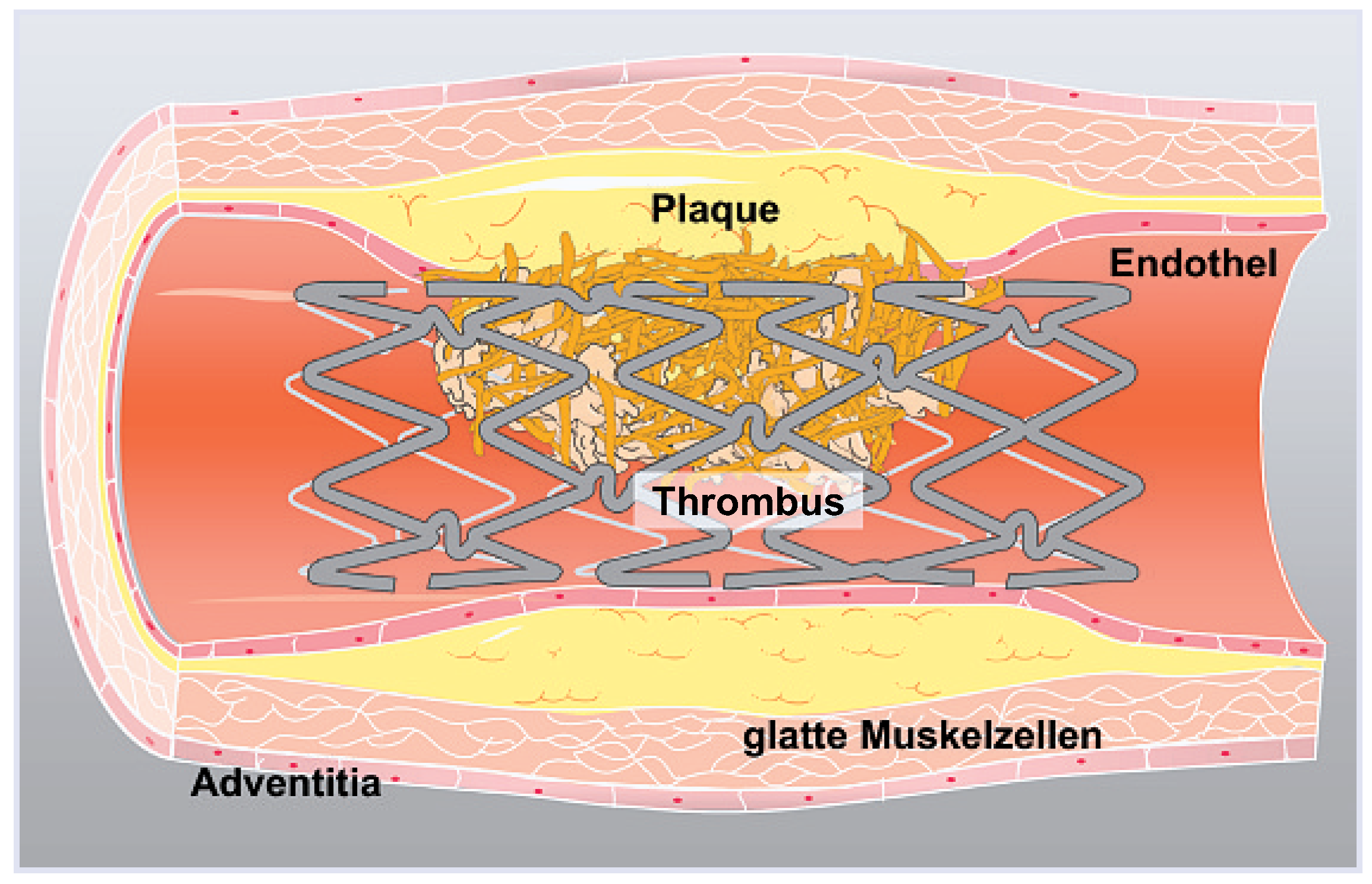 Cardiovascmed 12 00078 g004