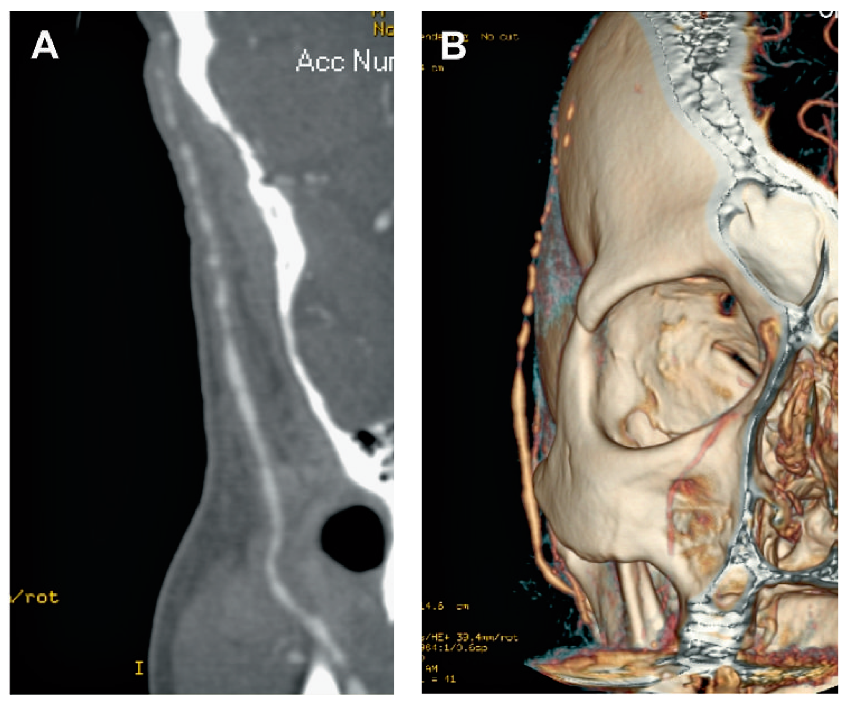 Cardiovascmed 12 00143 g005