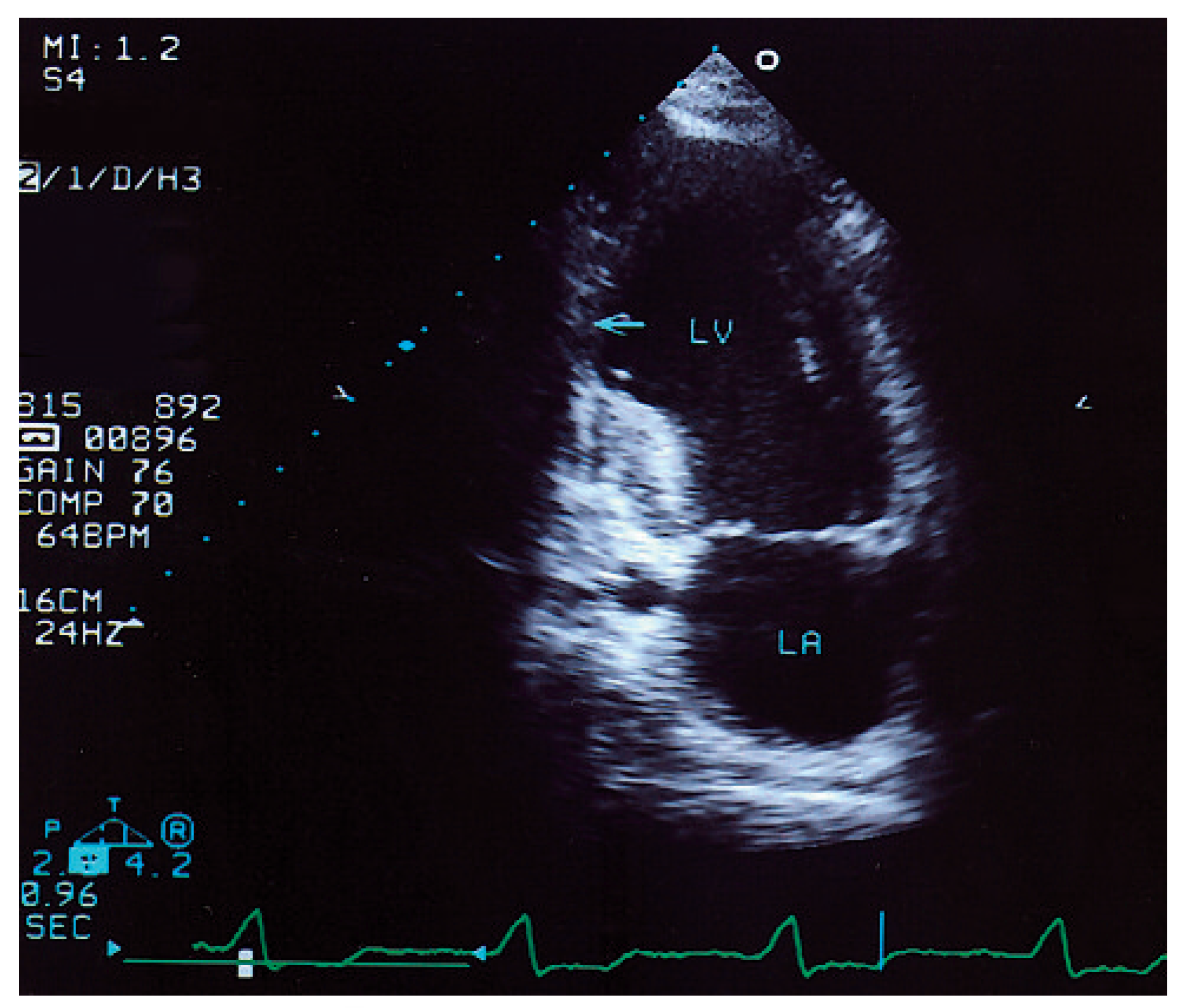 Cardiovascmed 12 00164 g002