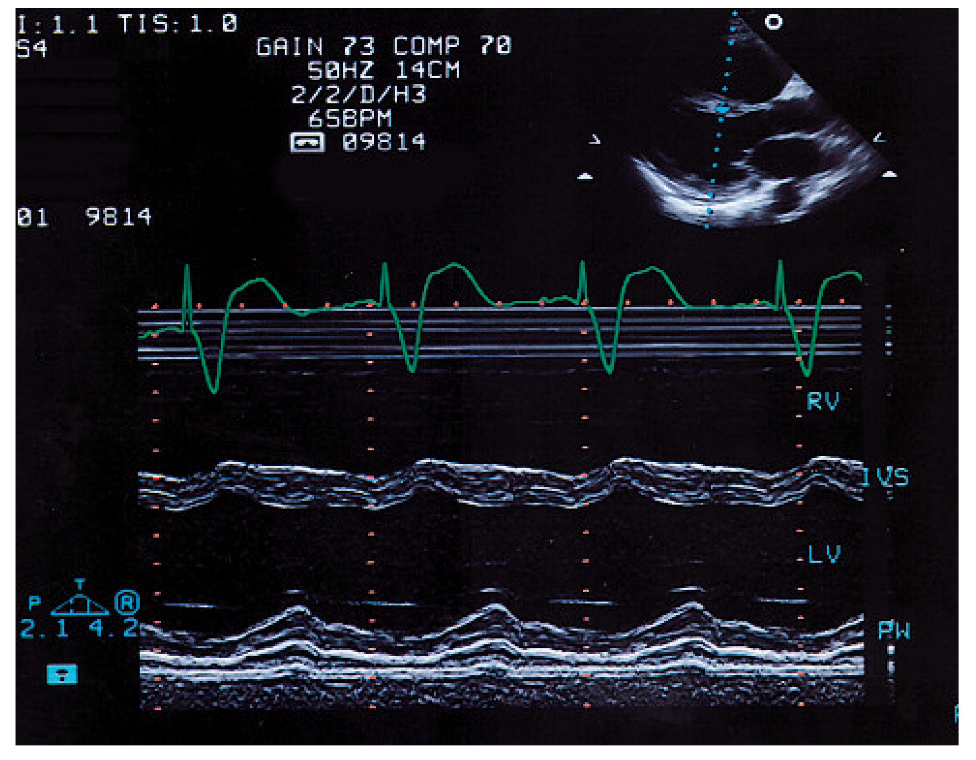 Cardiovascmed 12 00164 g006