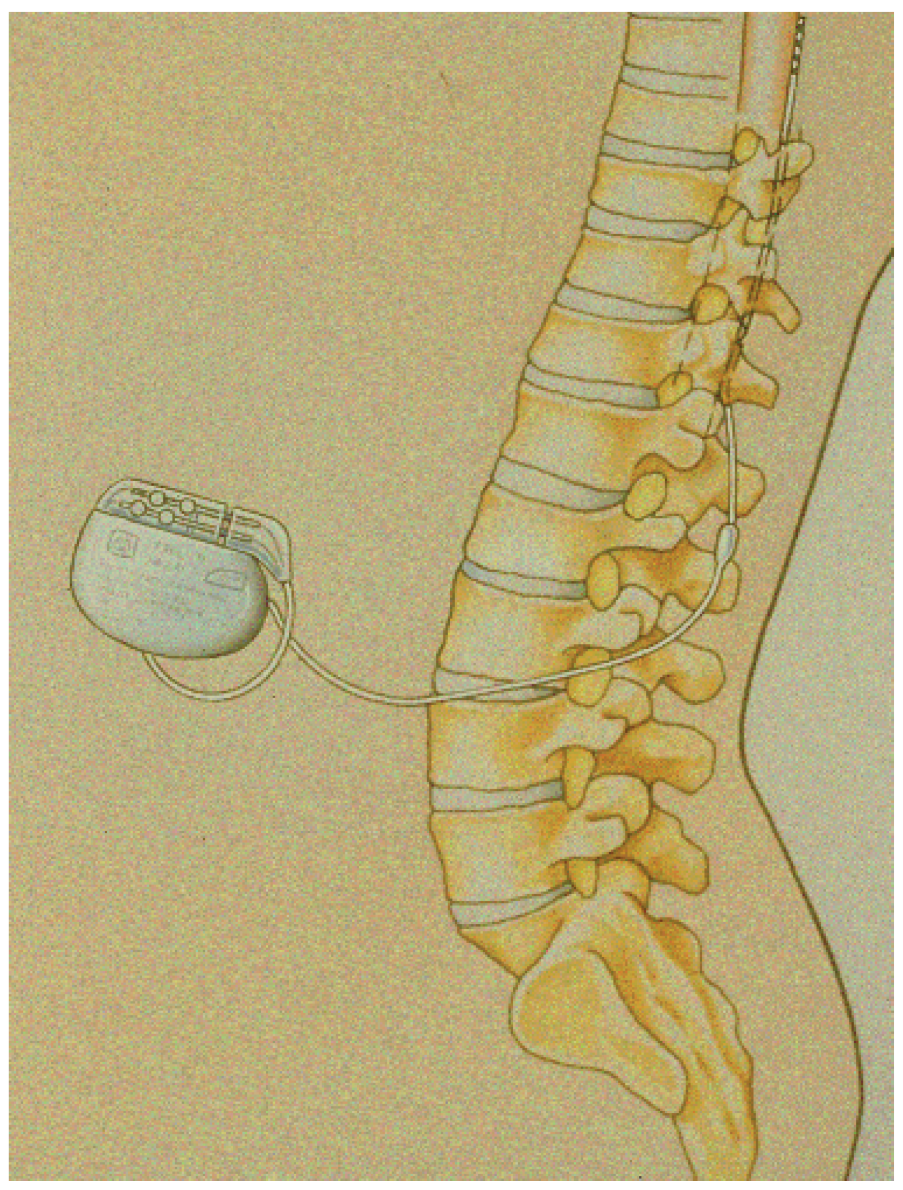 Cardiovascmed 13 00097 g001 Cardiovascmed 13 00097 g001