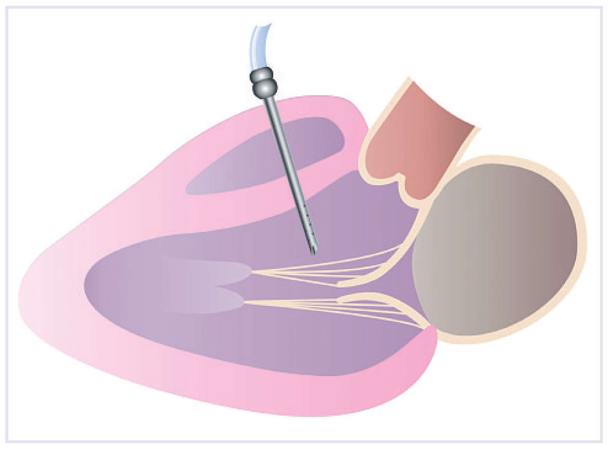 Cardiovascmed 13 00167 g007