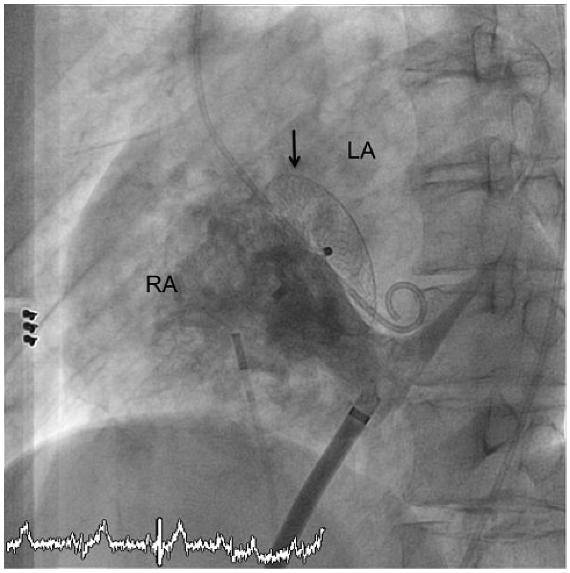 Cardiovascmed 13 00290 g004 Cardiovascmed 13 00290 g004
