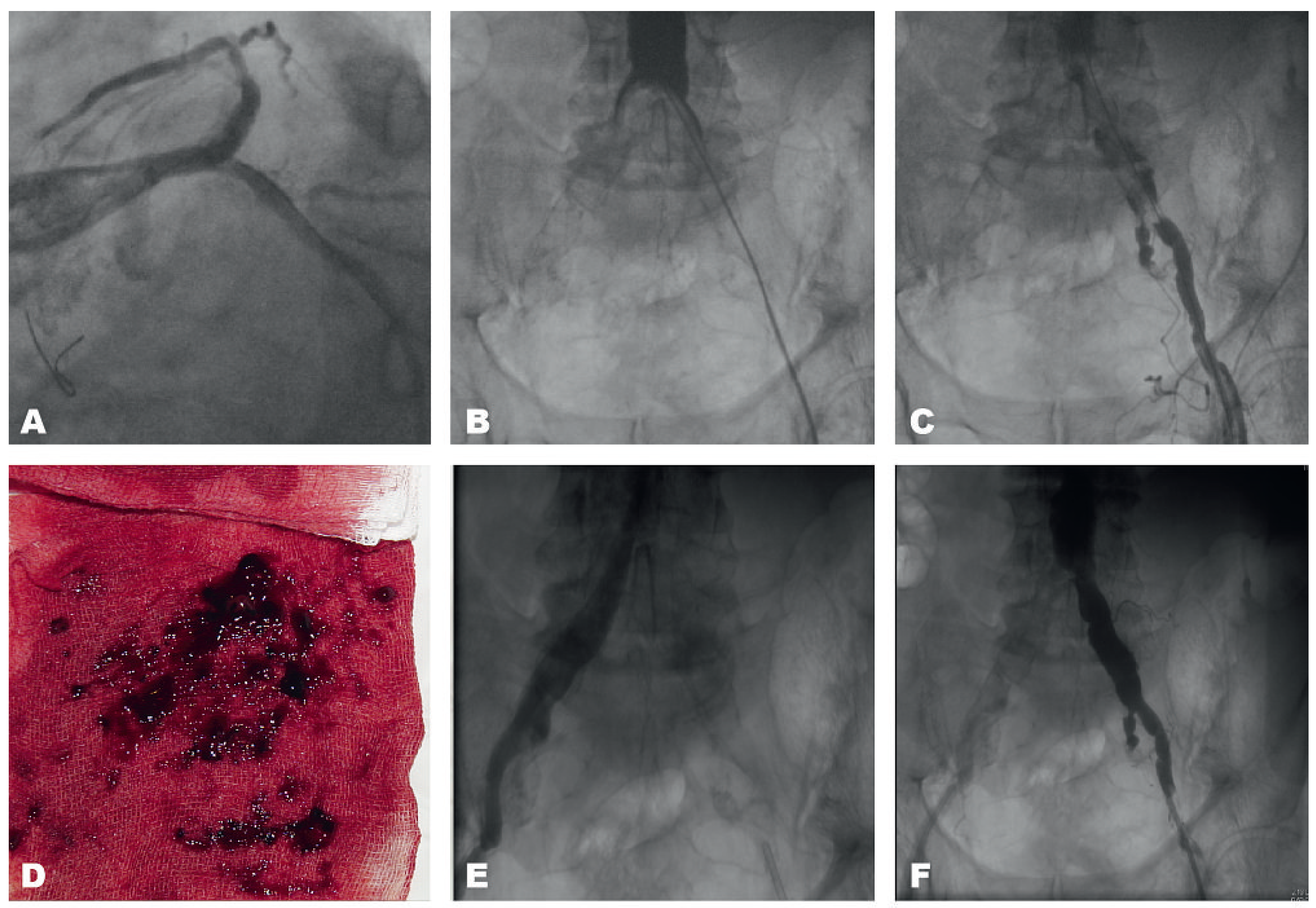 Cardiovascmed 13 00292 g001 Cardiovascmed 13 00292 g001