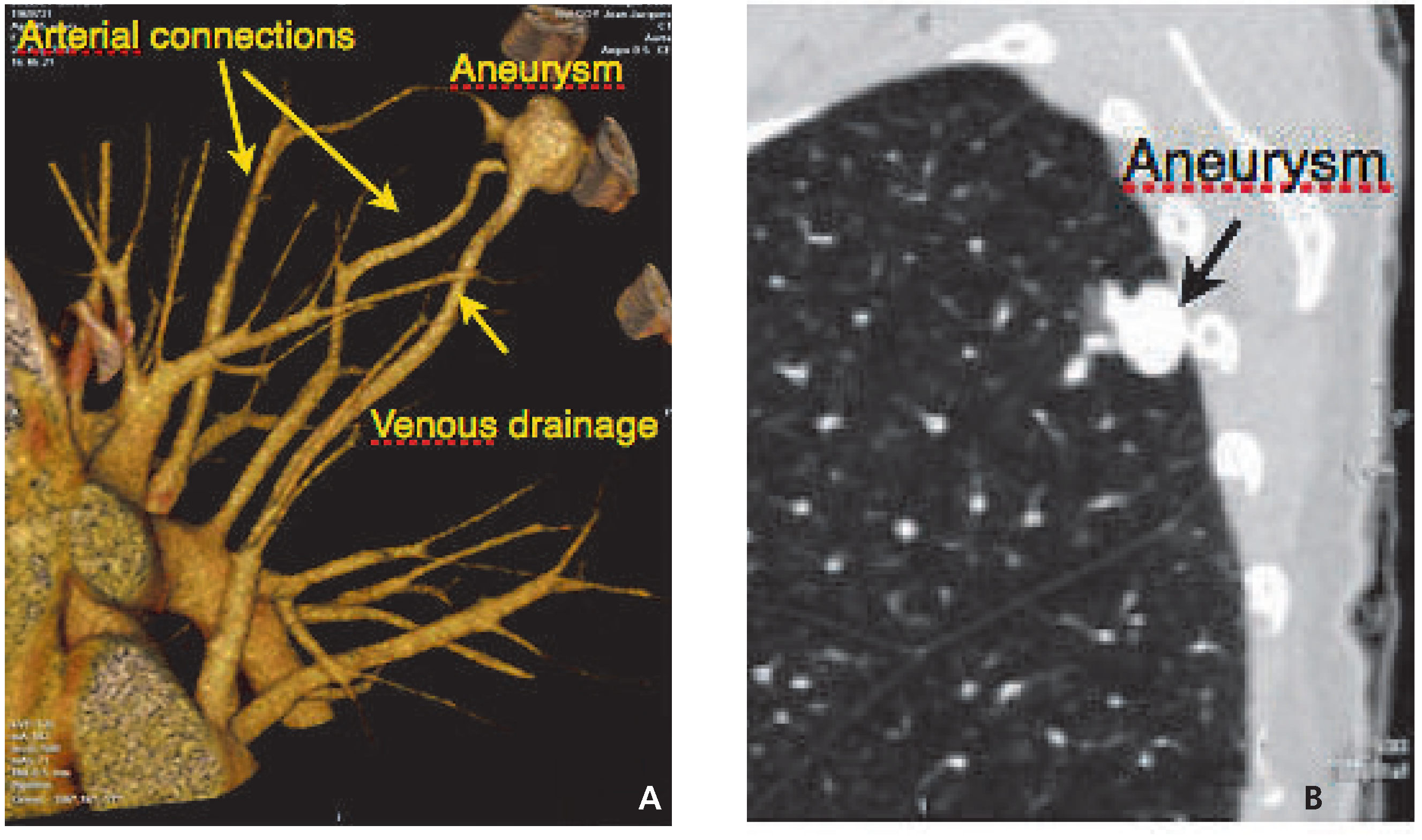 Cardiovascmed 13 00318 g002 Cardiovascmed 13 00318 g002