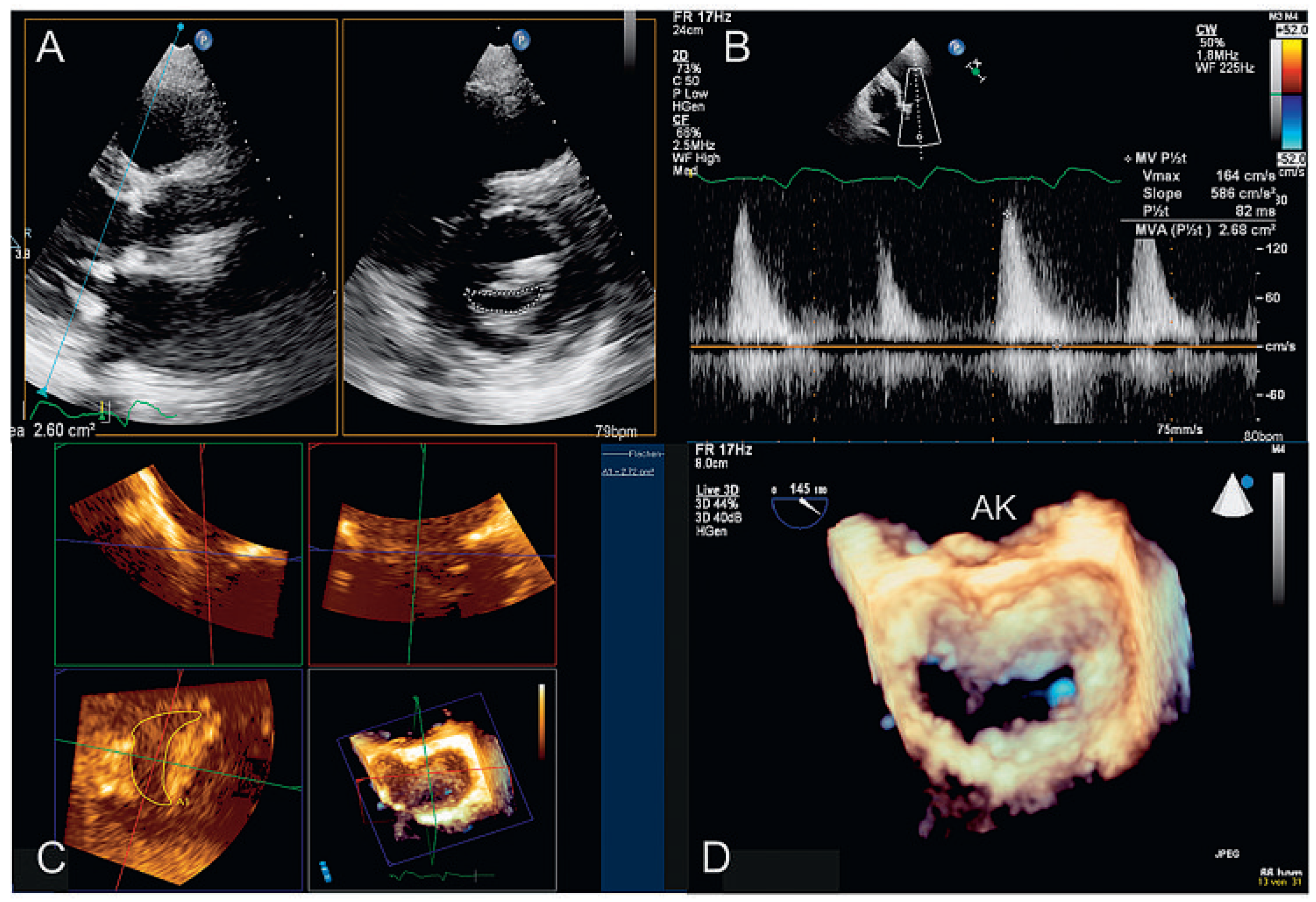 Cardiovascmed 14 00004 g004 Cardiovascmed 14 00004 g004