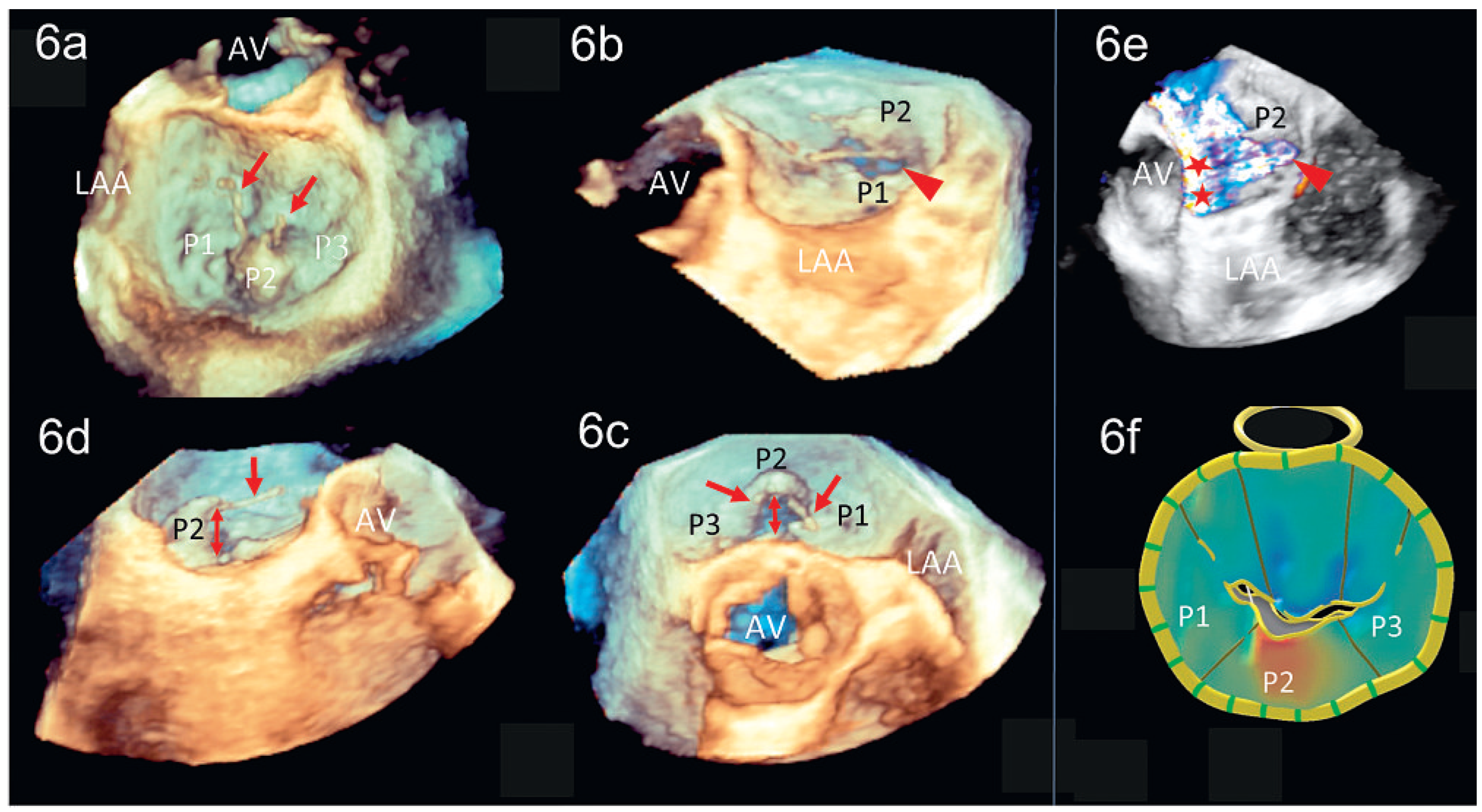 Cardiovascmed 14 00004 g006 Cardiovascmed 14 00004 g006