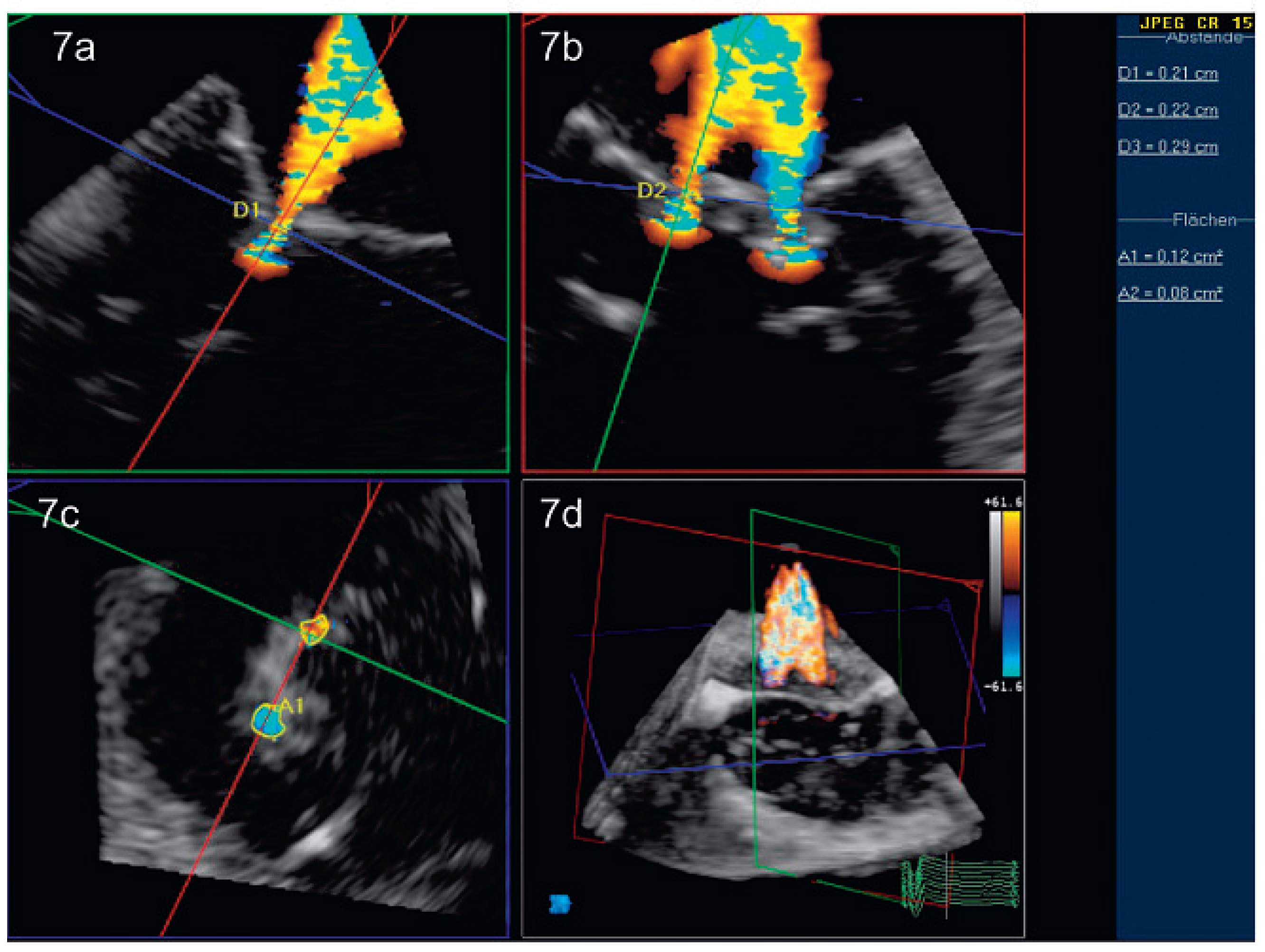 Cardiovascmed 14 00004 g007 Cardiovascmed 14 00004 g007