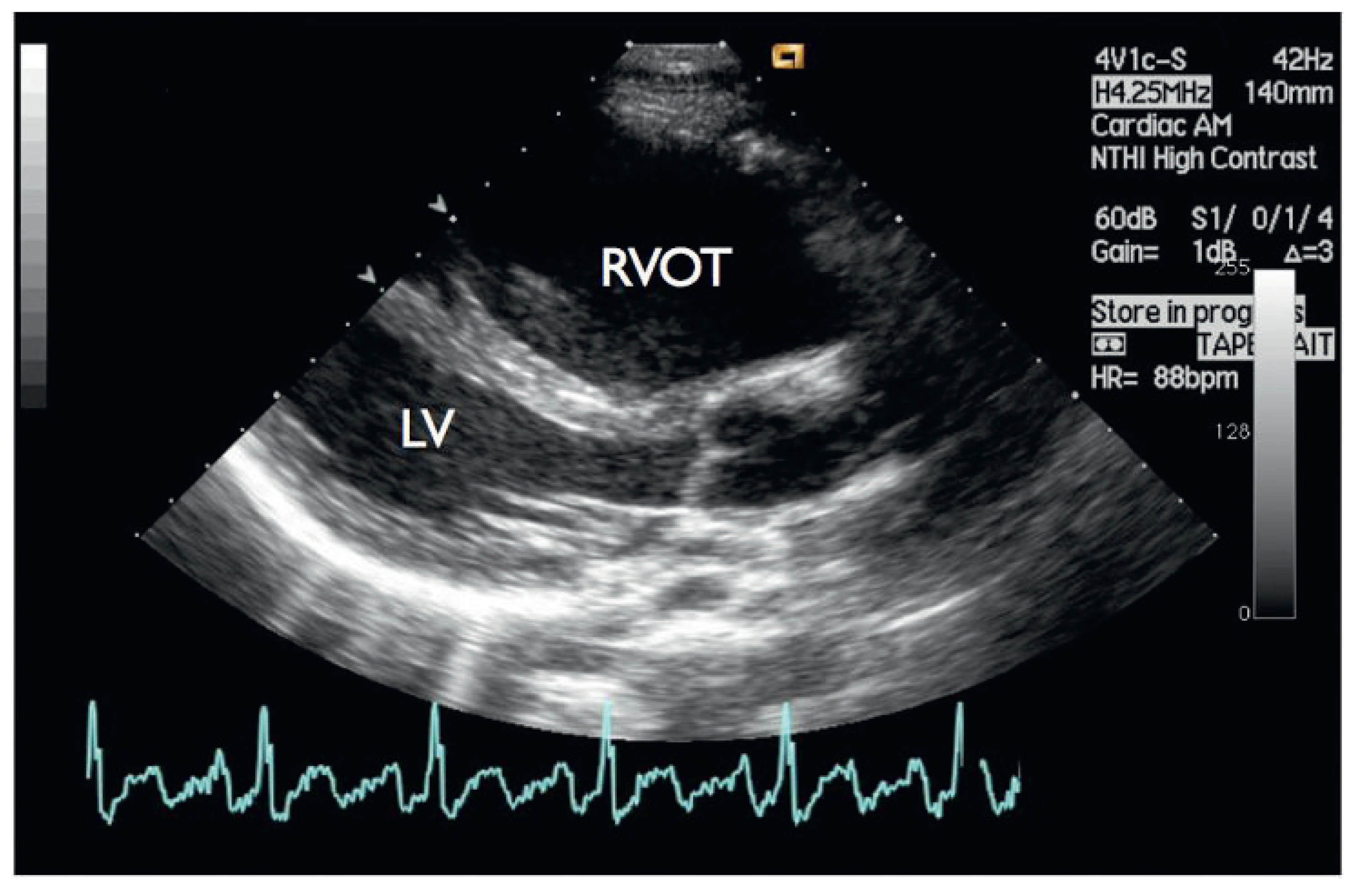Cardiovascmed 14 00098 g003 Cardiovascmed 14 00098 g003